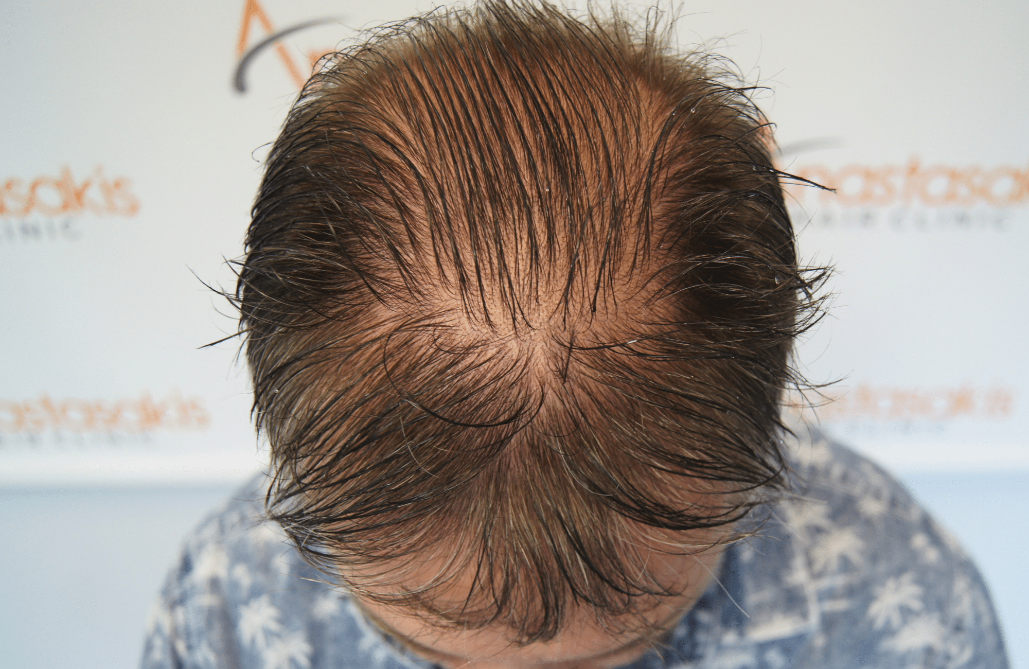 hair transplant result