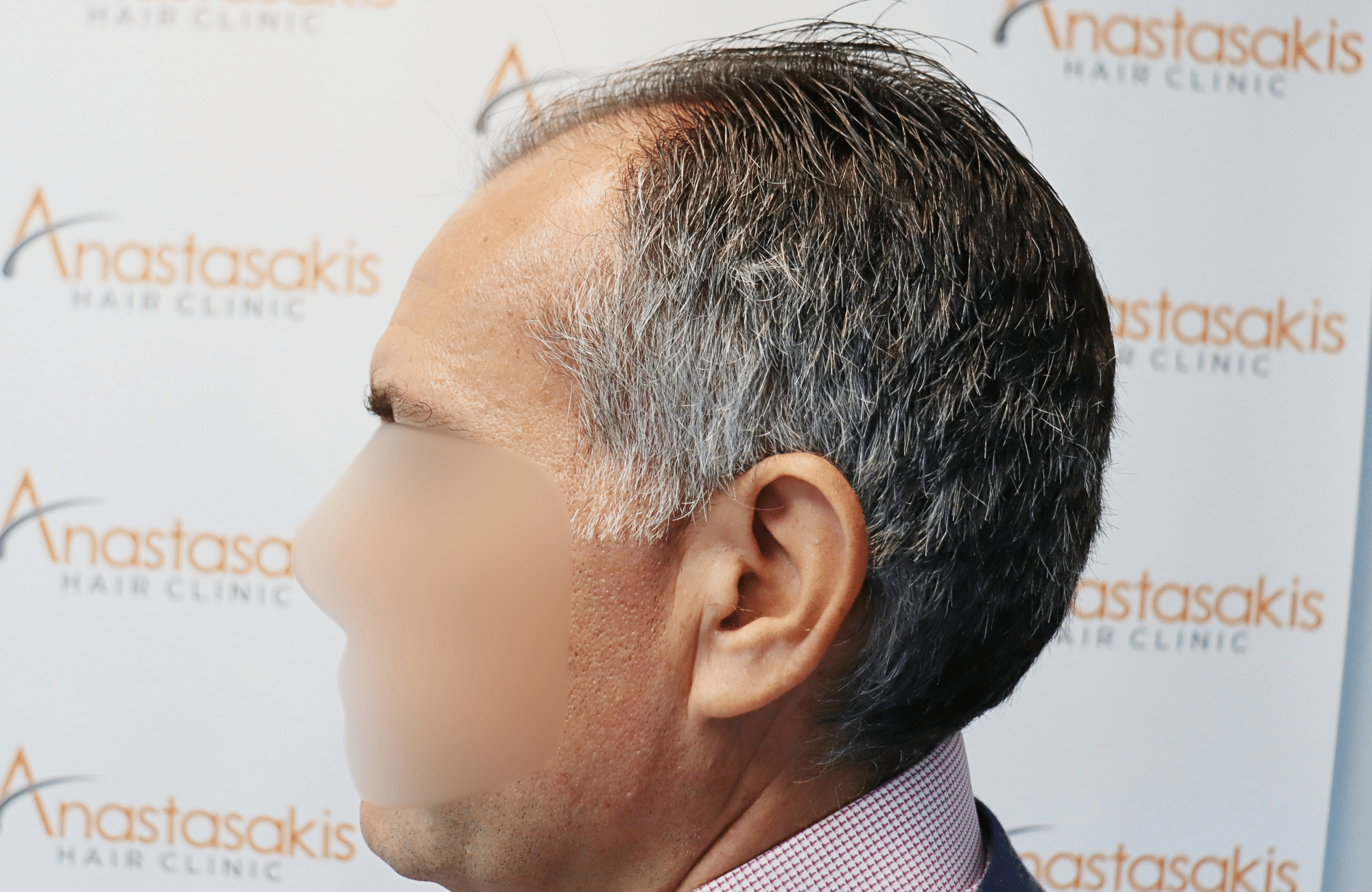 hair transplant result 2600