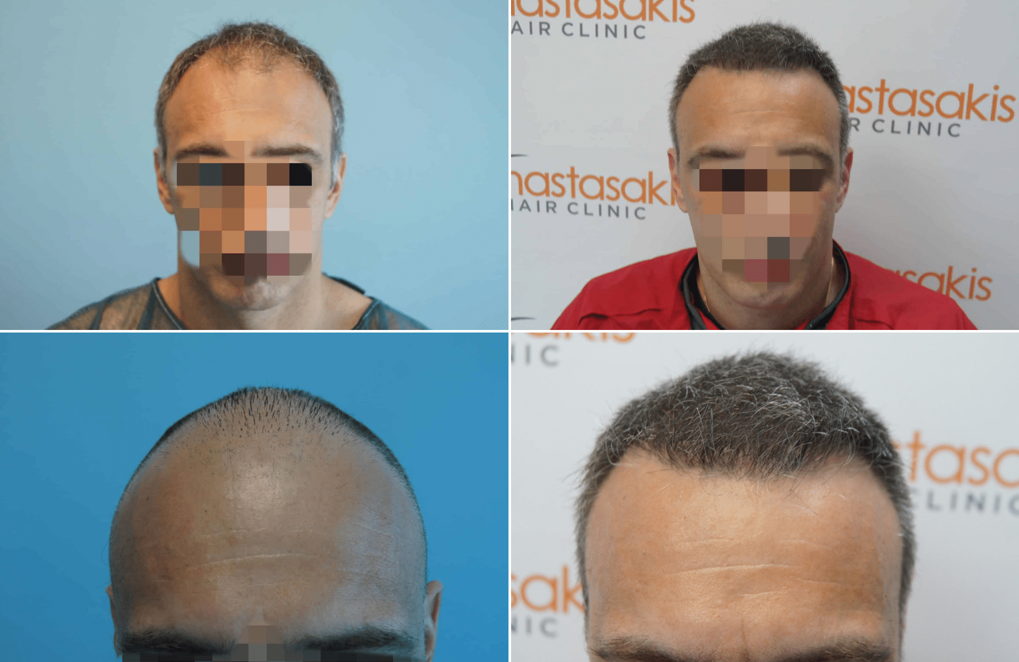 https://www.anastasakishairclinic.gr/portfolio/apotelesma-metamosxefsis-mallion-anastasakis-hair-clinic-93/