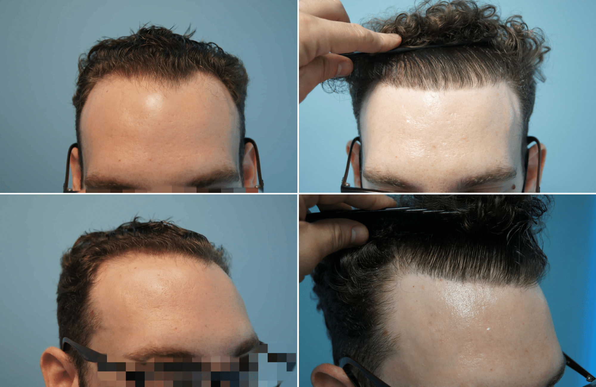 https://www.anastasakishairclinic.gr/portfolio/apotelesma-metamosxefsis-mallion-anastasakis-hair-clinic-96/