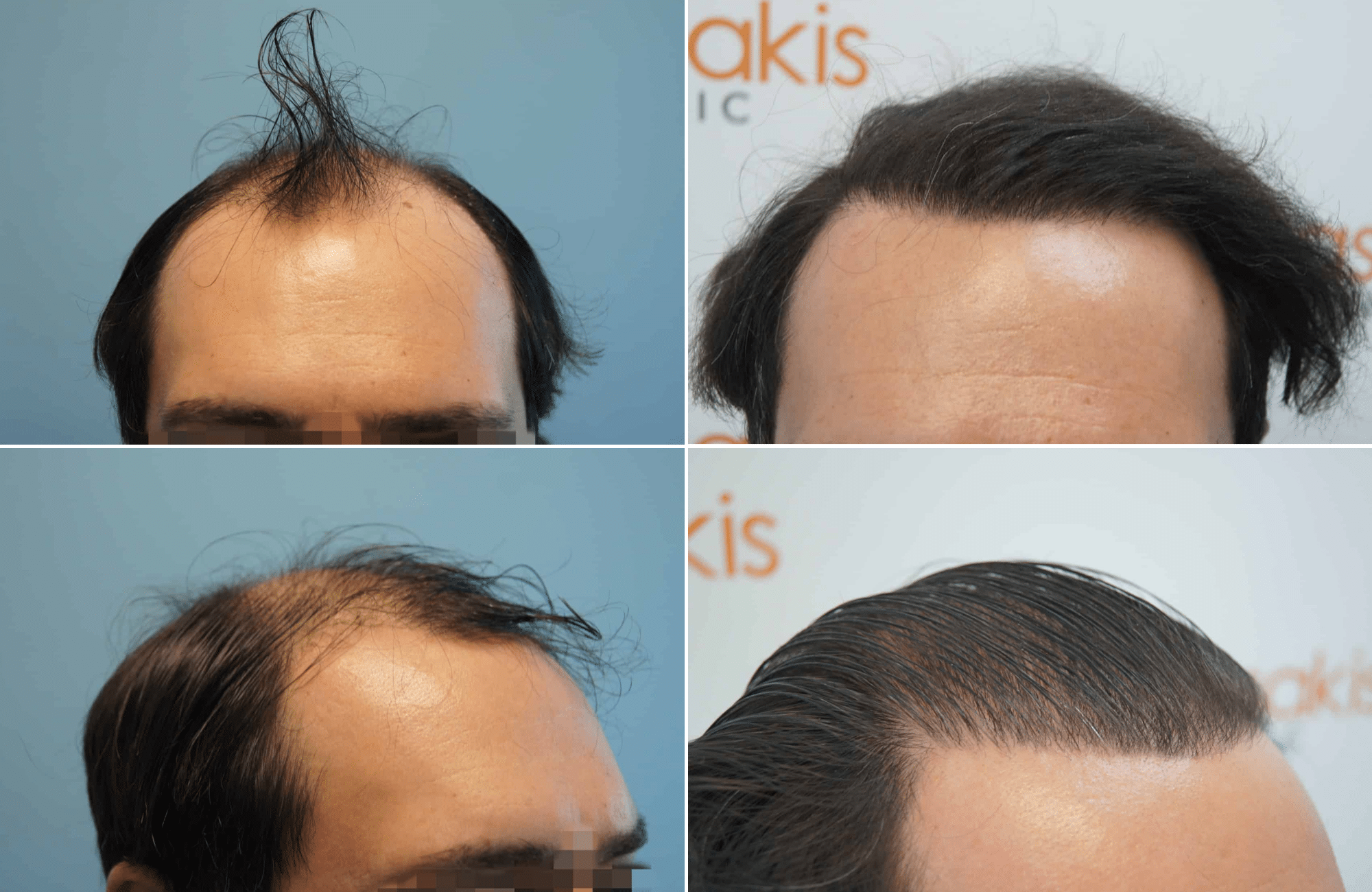 https://www.anastasakishairclinic.gr/portfolio/apotelesma-metamosxefsis-mallion-anastasakis-hair-clinic-99/