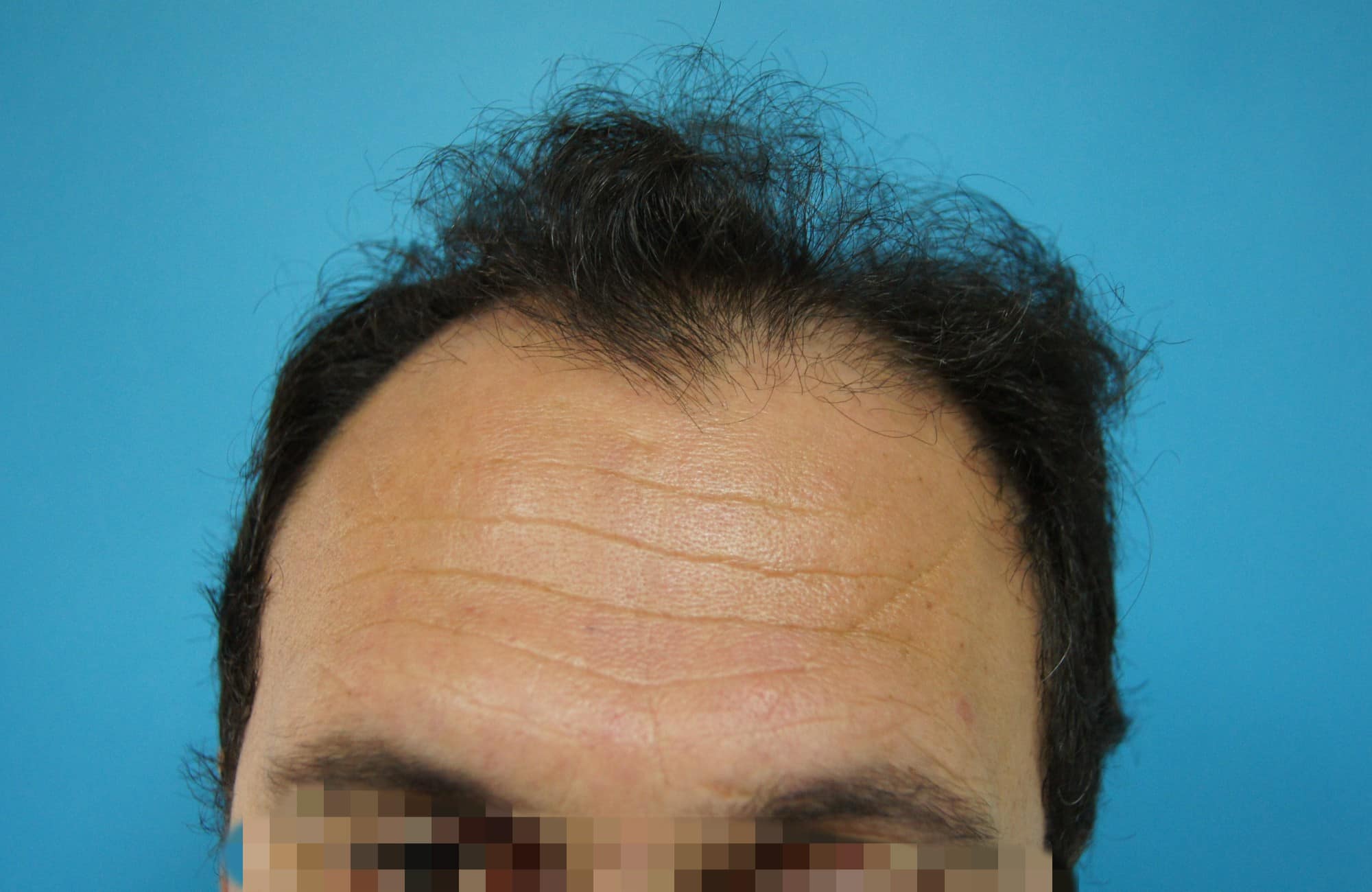 https://www.anastasakishairclinic.gr/portfolio/apotelesma-metamosxefsis-mallion-anastasakis-hair-clinic-48/