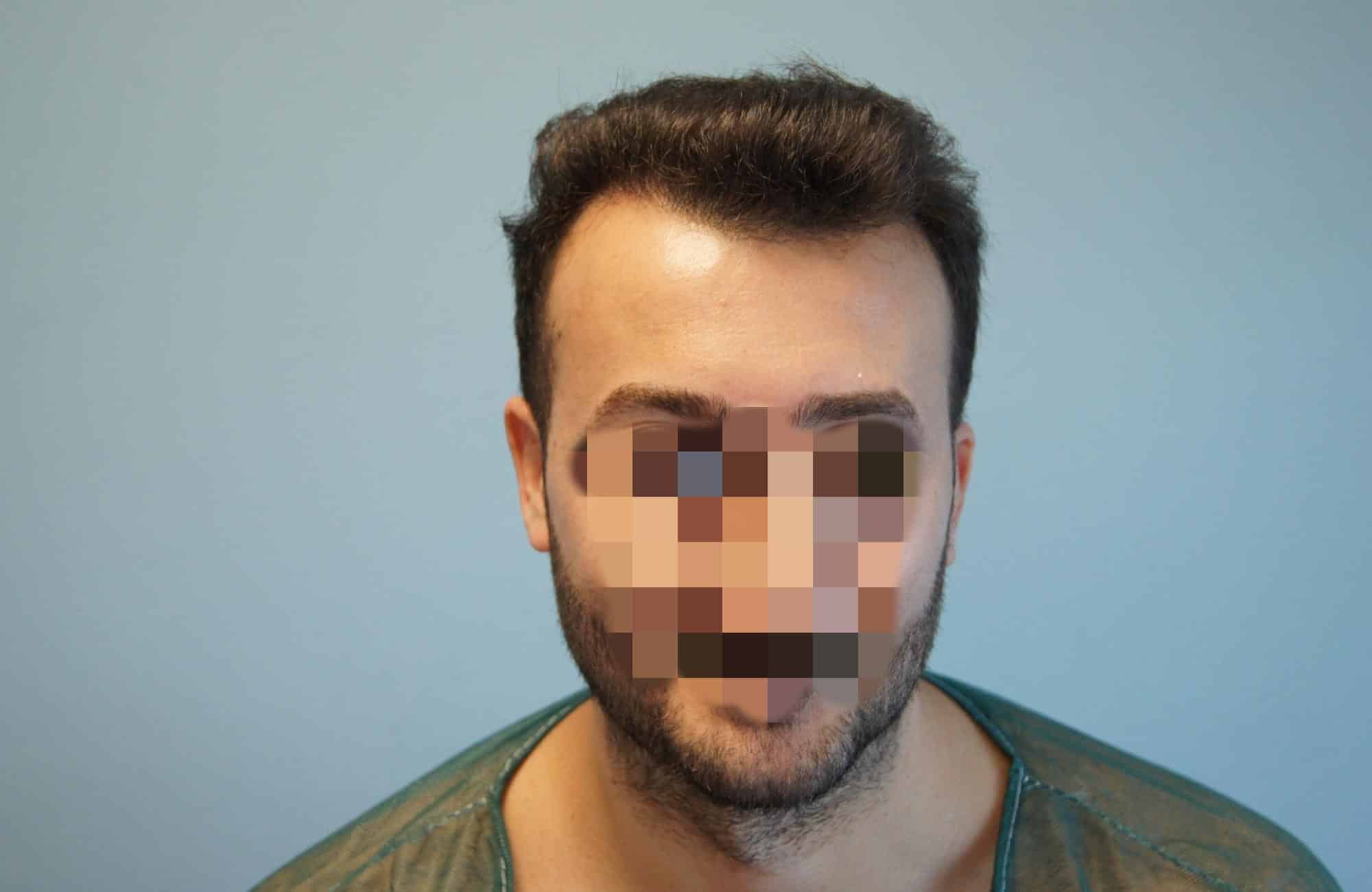 μεταμοσχευση μαλλιων πριν και μετα