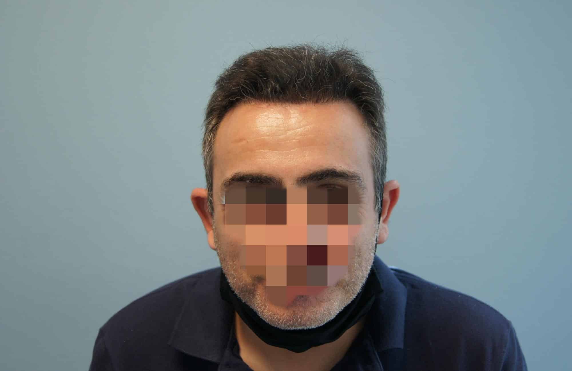 μεταμοσχευση μαλλιων πριν και μετα