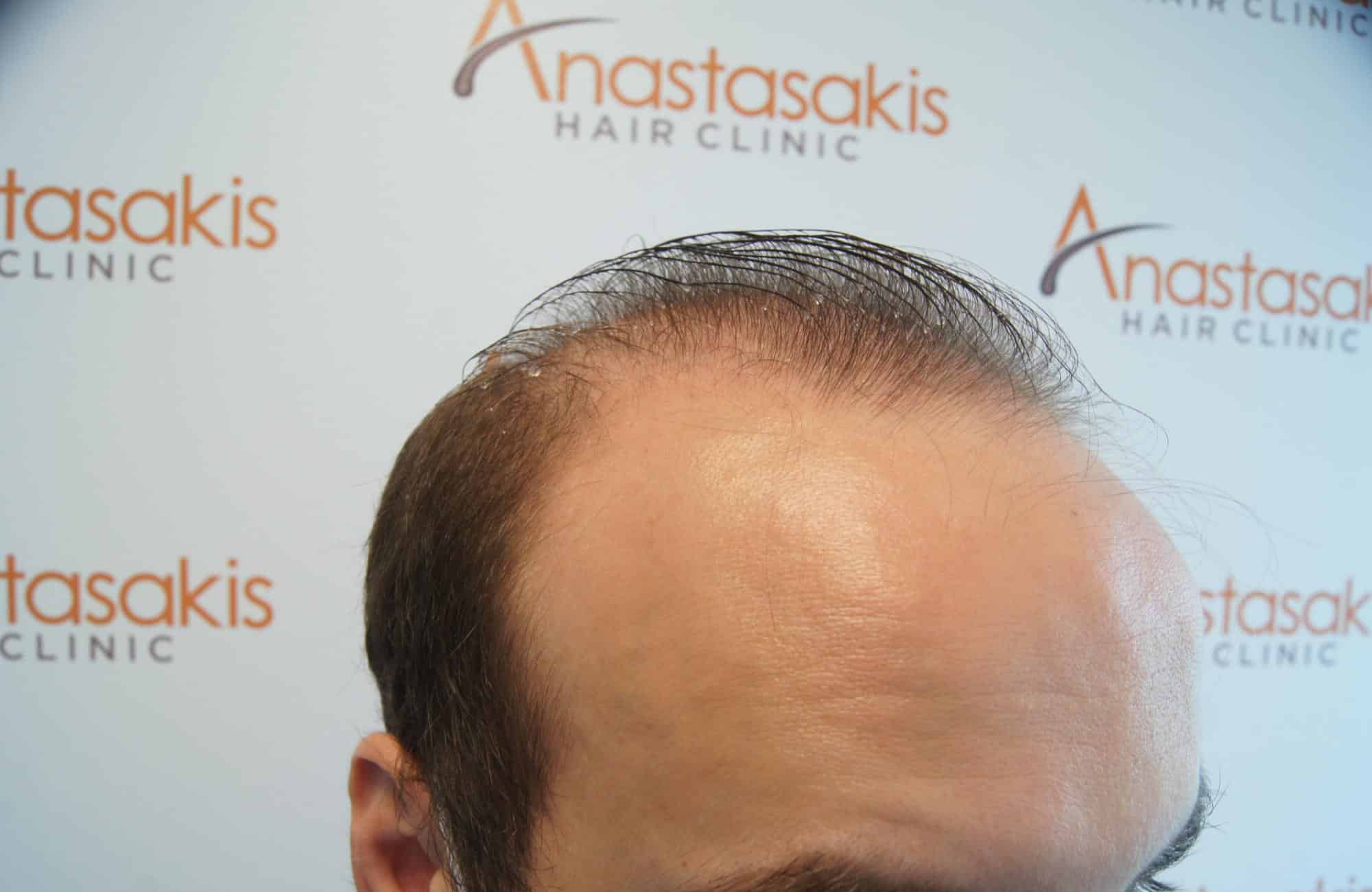 μεταμοσχευση μαλλιων πριν και μετα
