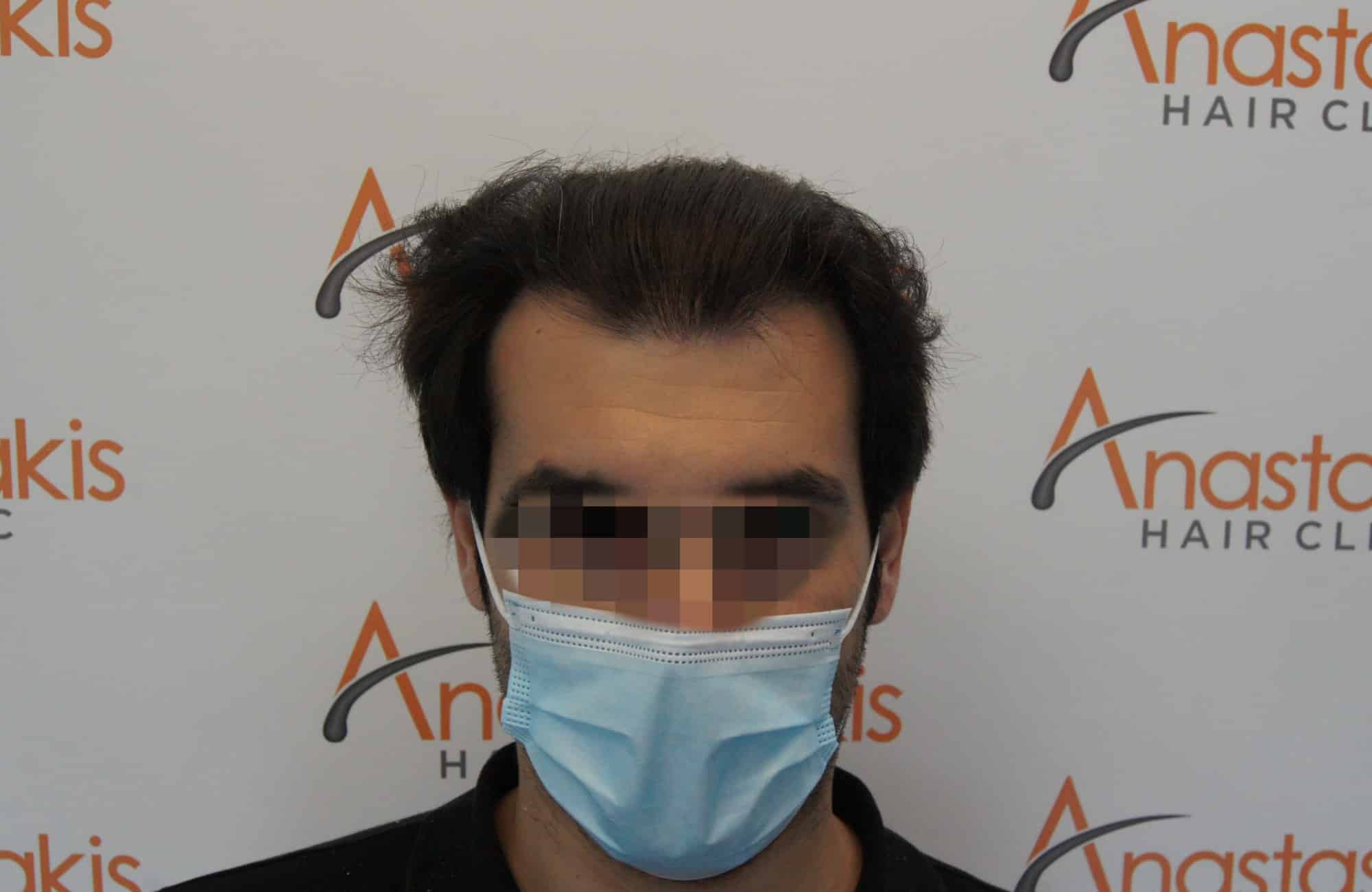 μεταμοσχευση μαλλιων πριν και μετα