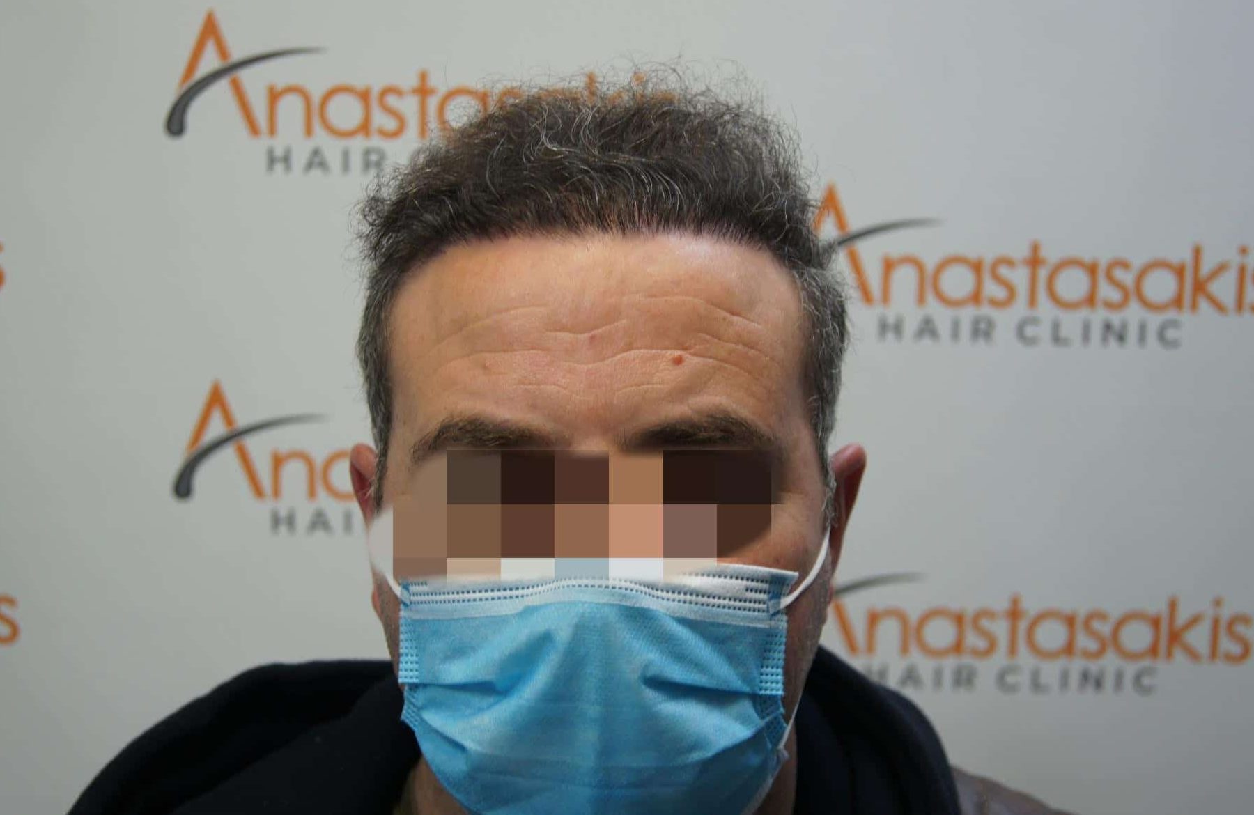 μεταμοσχευση μαλλιων πριν και μετα
