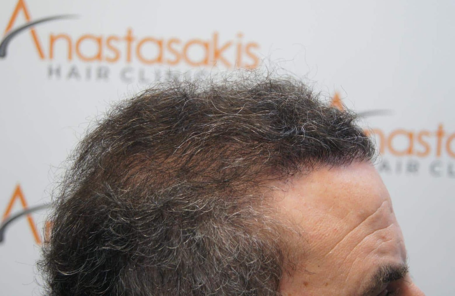 μεταμοσχευση μαλλιων πριν και μετα