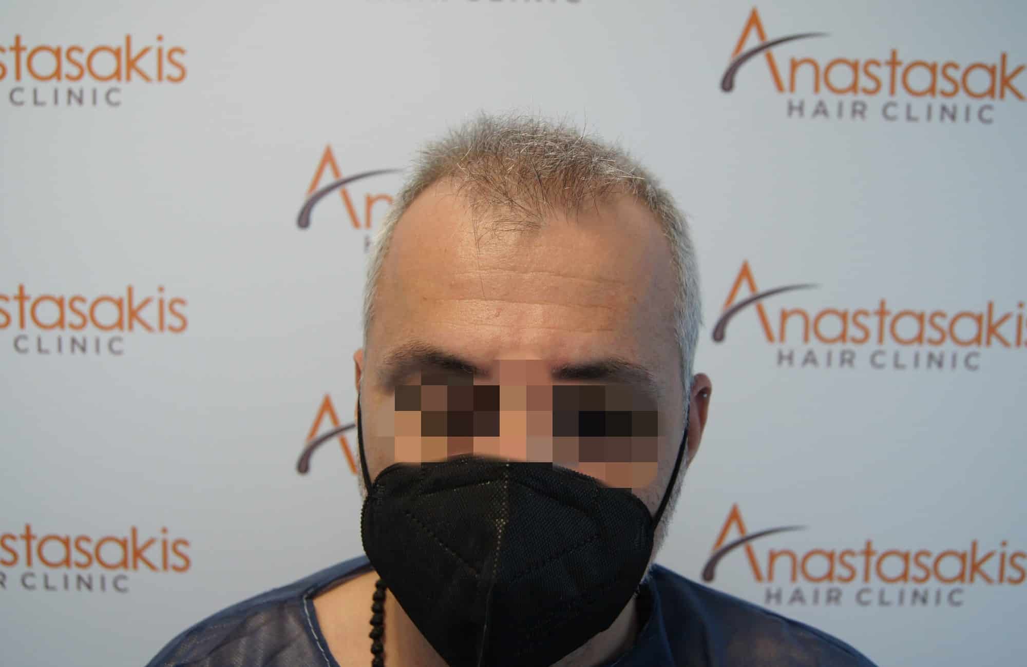 μεταμοσχευση μαλλιων πριν και μετα
