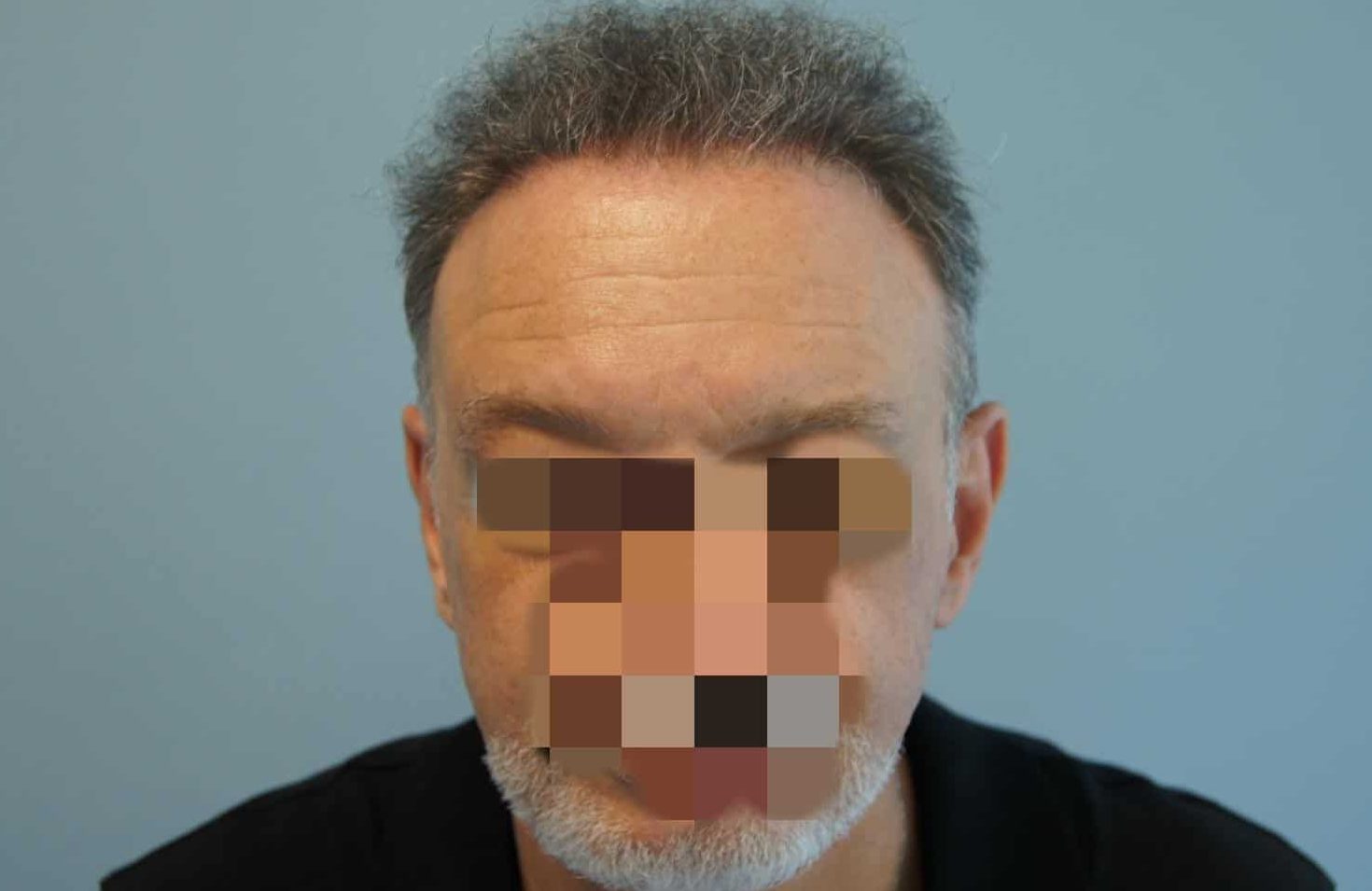 μεταμοσχευση μαλλιων πριν και μετα
