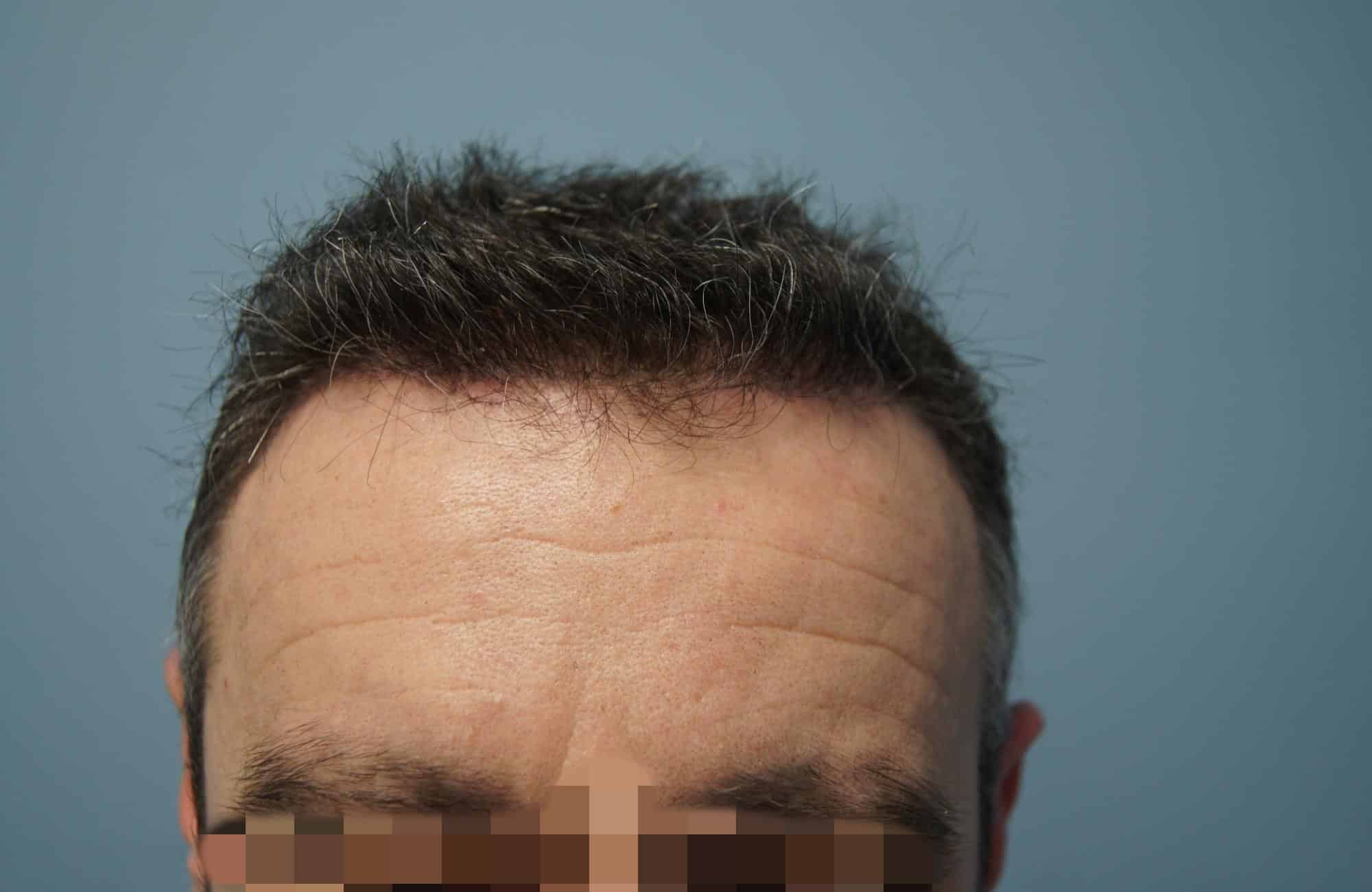 μεταμοσχευση μαλλιων πριν και μετα