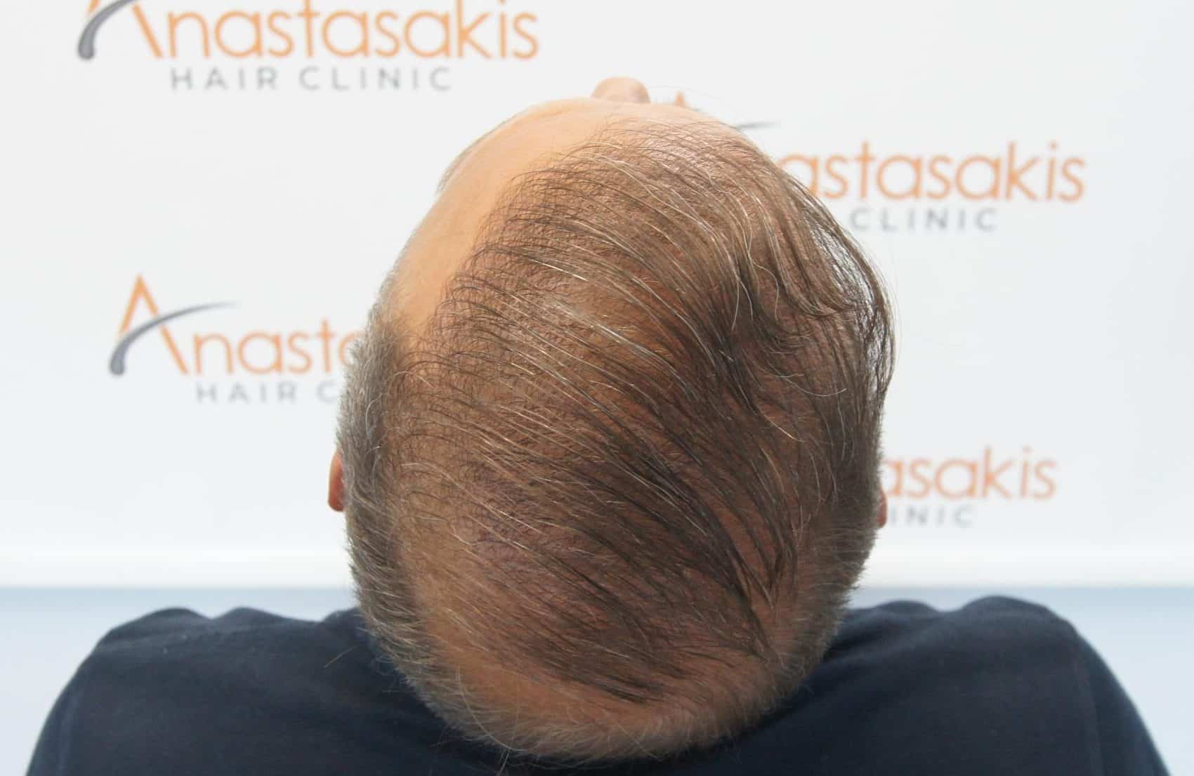 μεταμοσχευση μαλλιων πριν και μετα