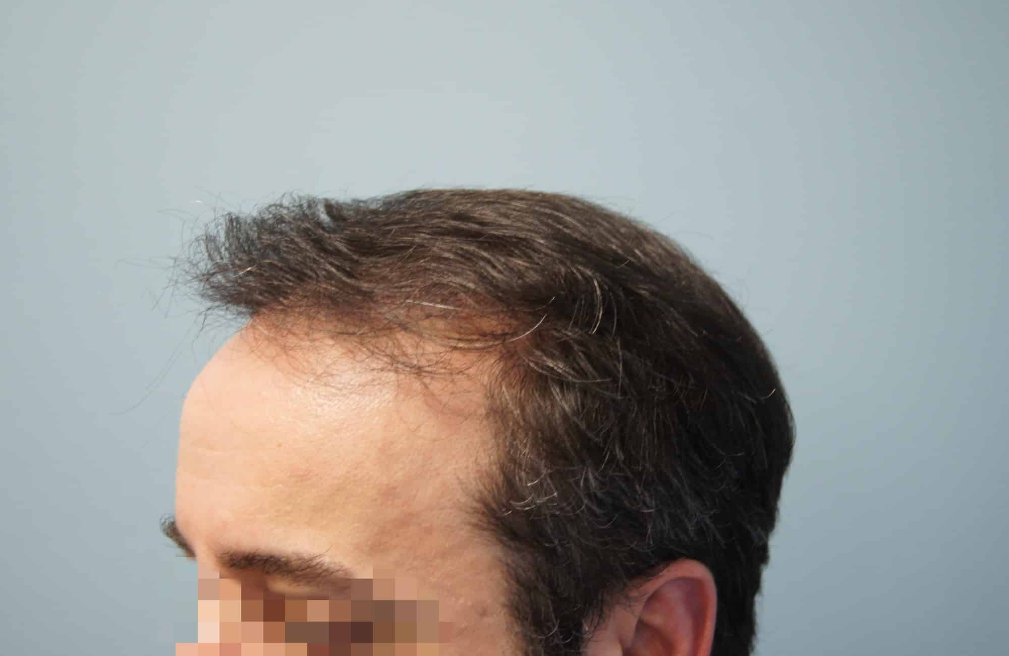 μεταμοσχευση μαλλιων πριν και μετα