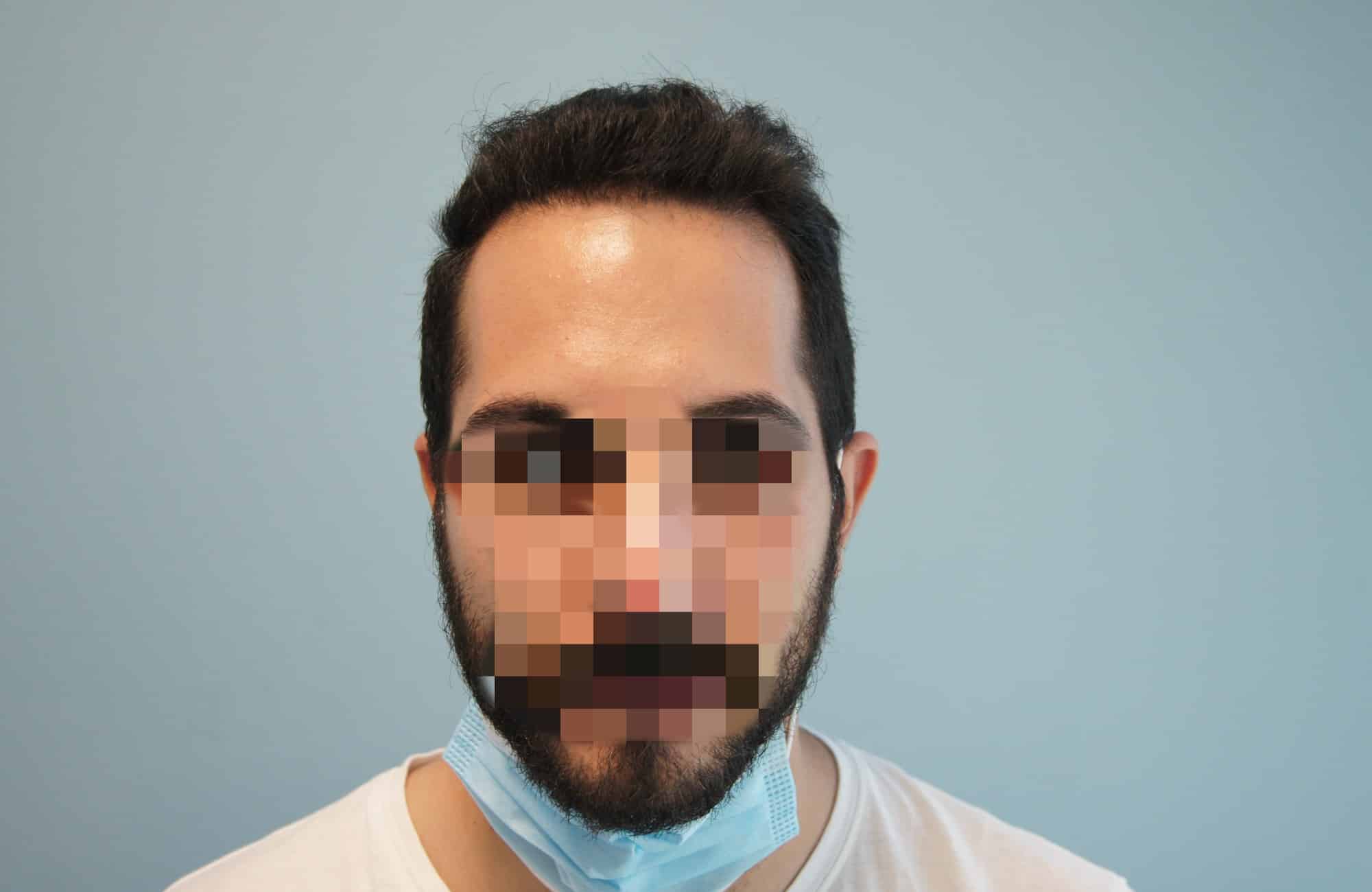μεταμοσχευση μαλλιων πριν και μετα