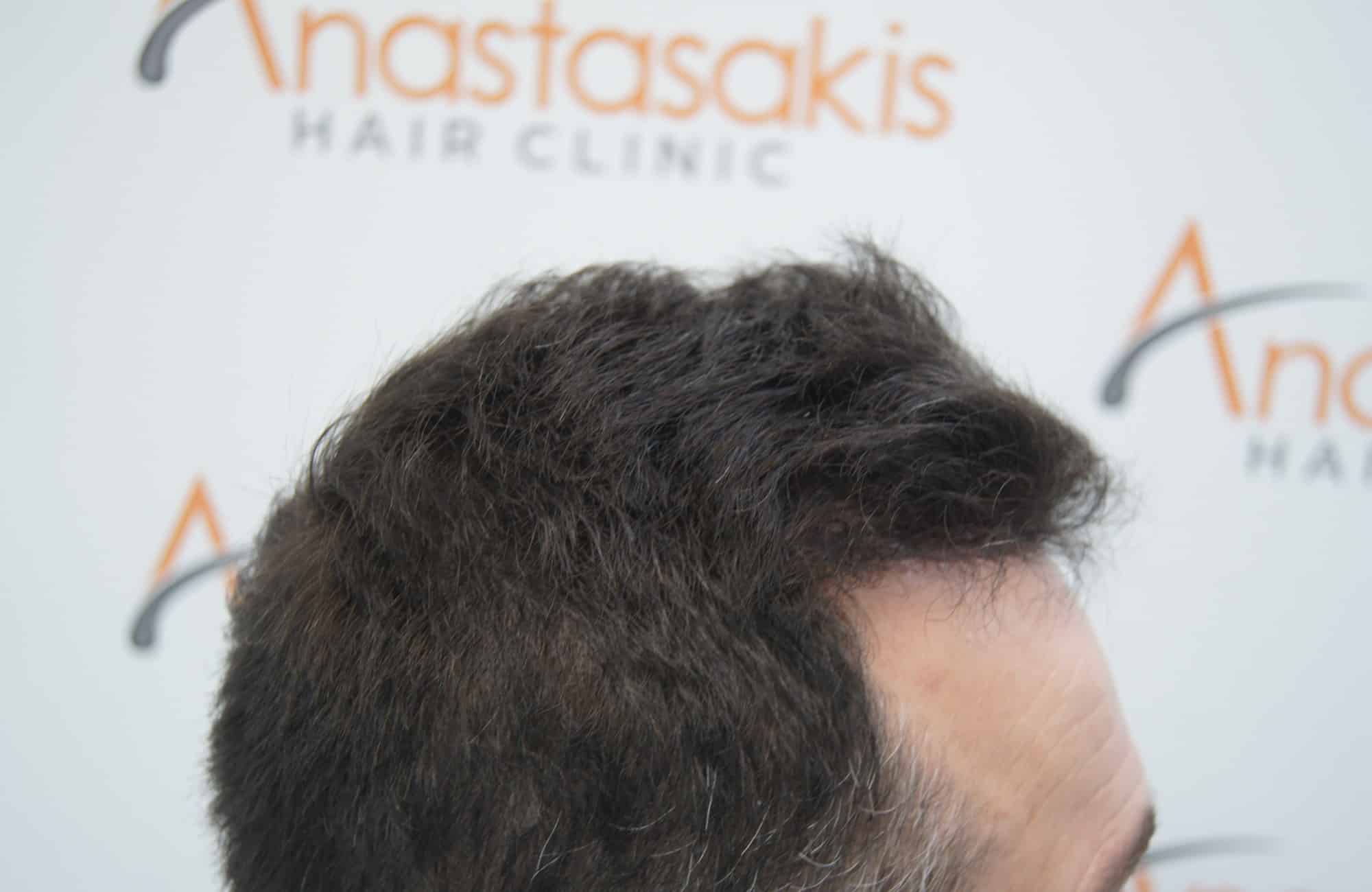 μεταμοσχευση μαλλιων πριν και μετα