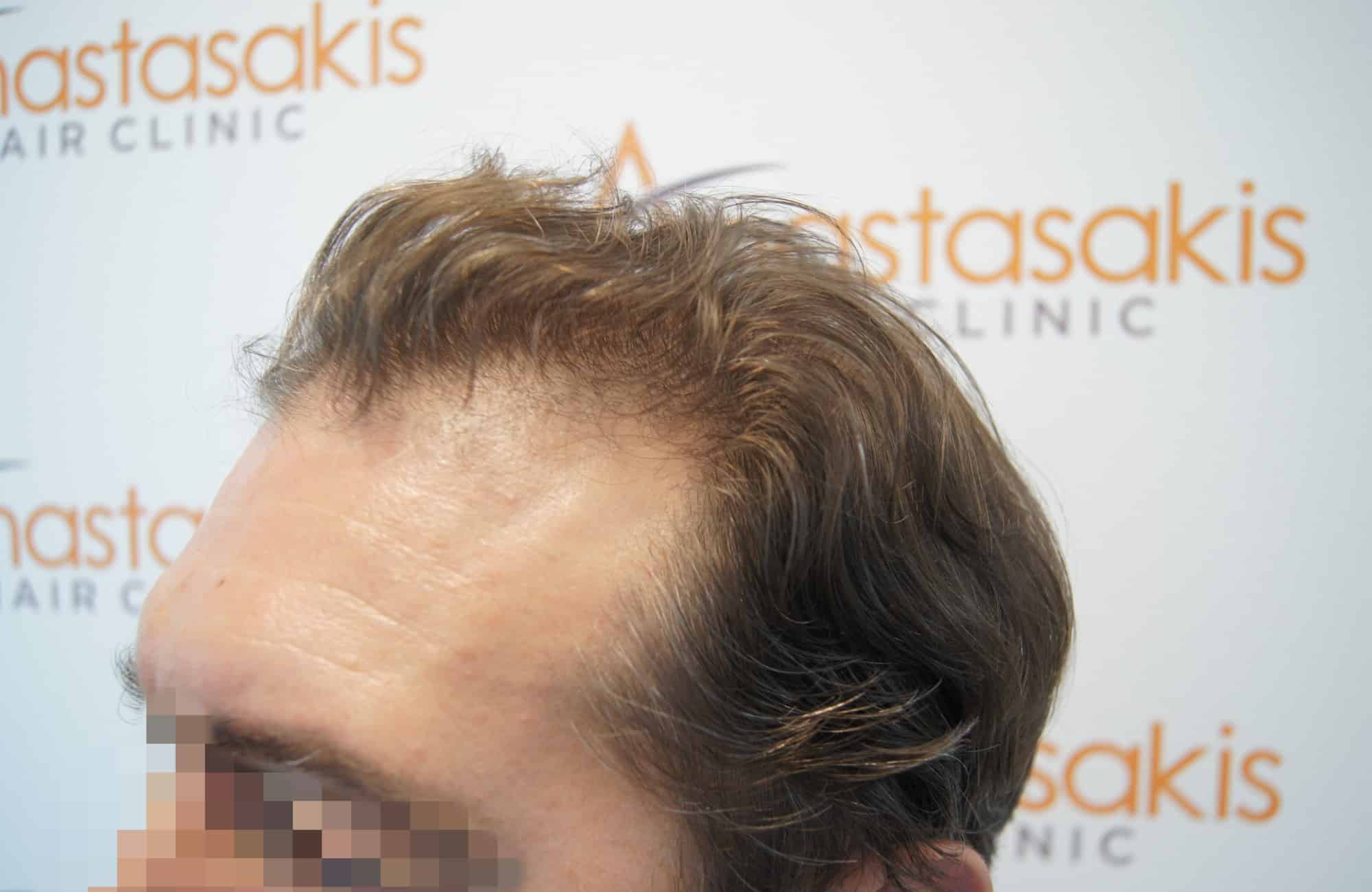 μεταμοσχευση μαλλιων πριν και μετα