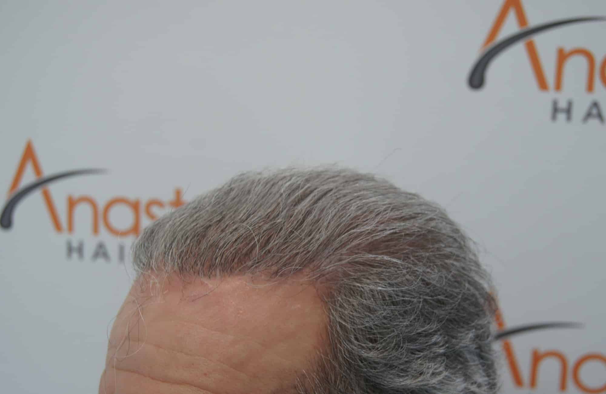 μεταμοσχευση μαλλιων πριν και μετα