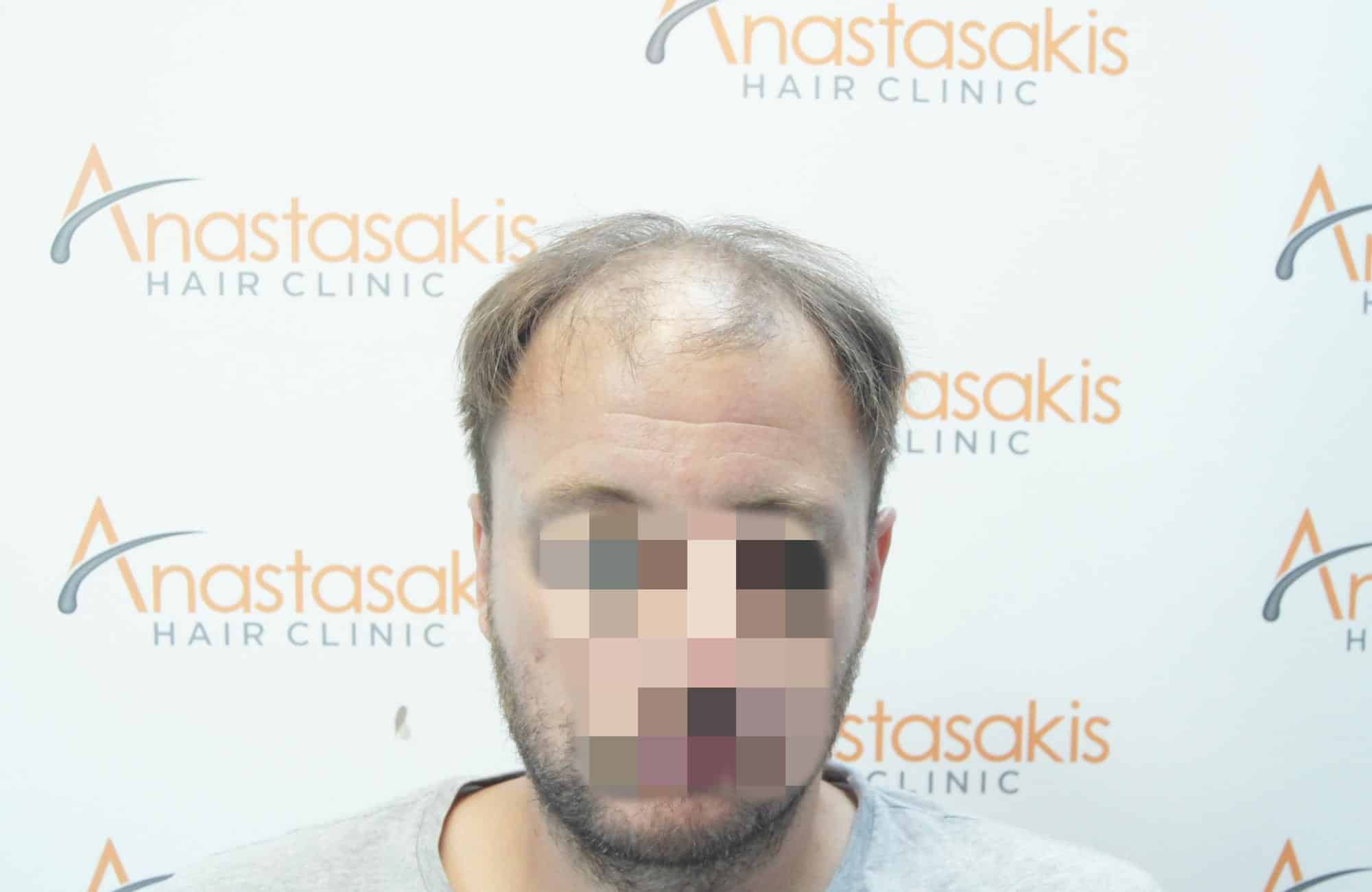 Αποτέλεσμα με 3700 FUs