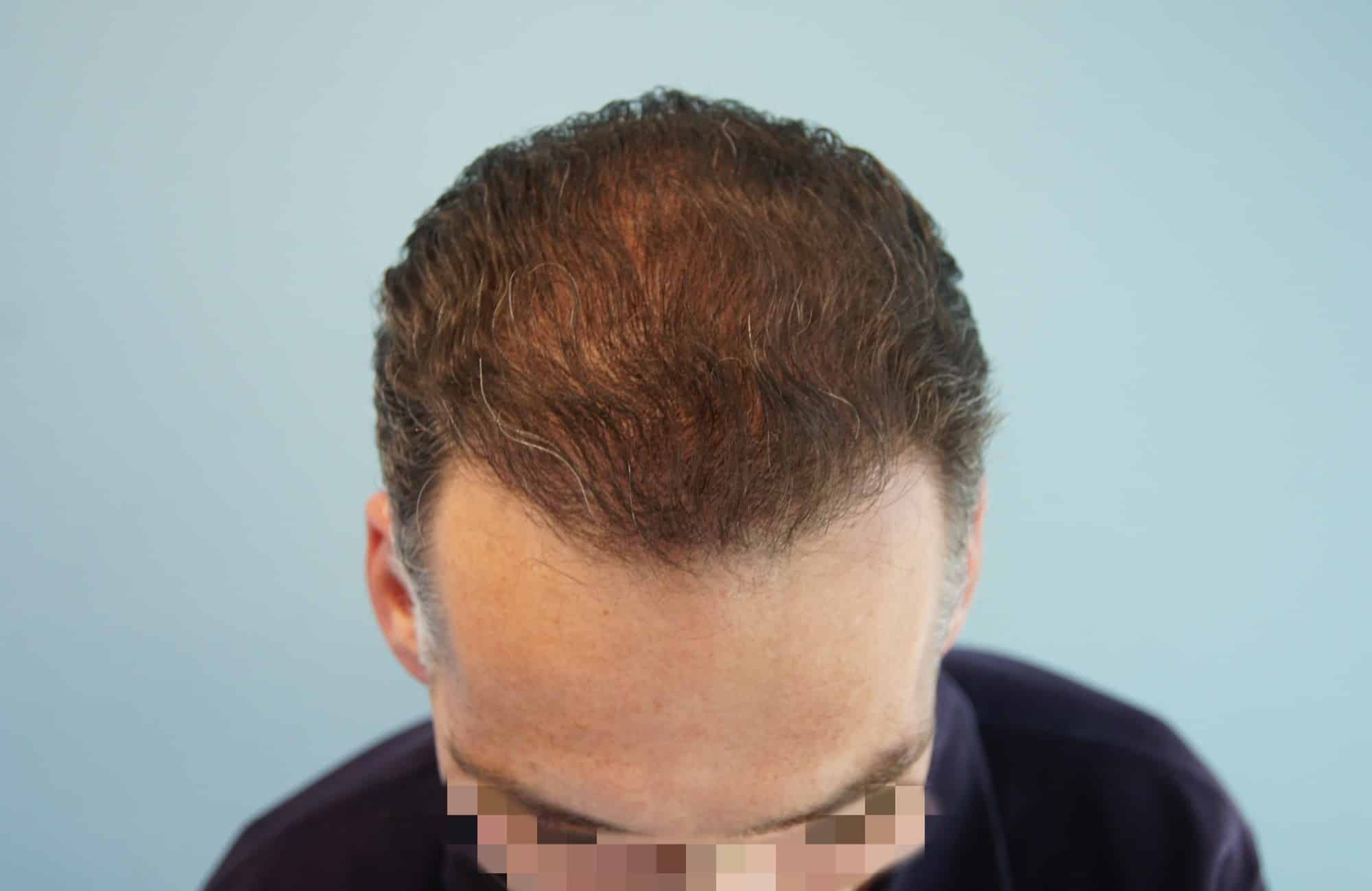 μεταμοσχευση μαλλιων πριν και μετα