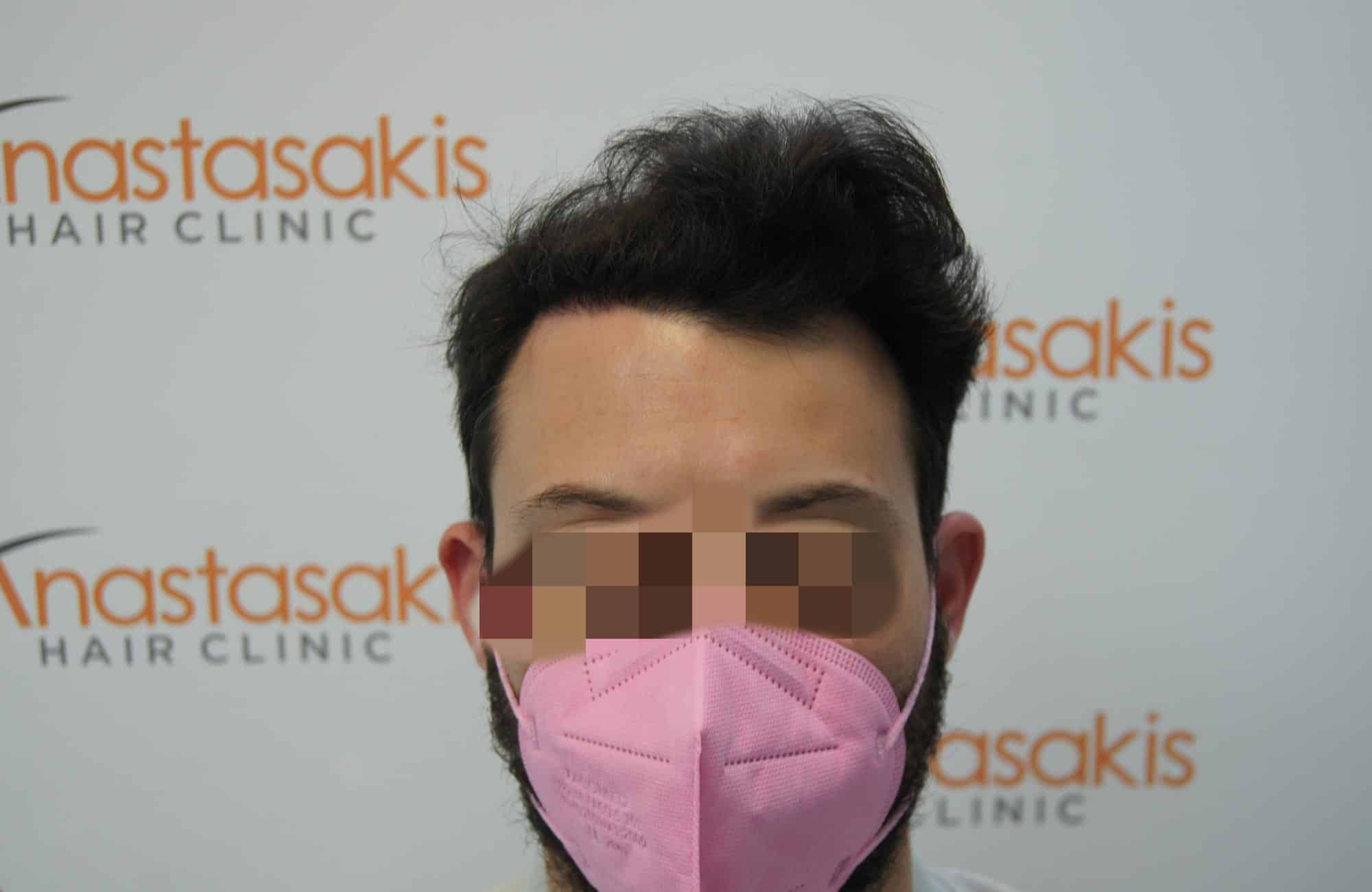 μεταμοσχευση μαλλιων πριν και μετα