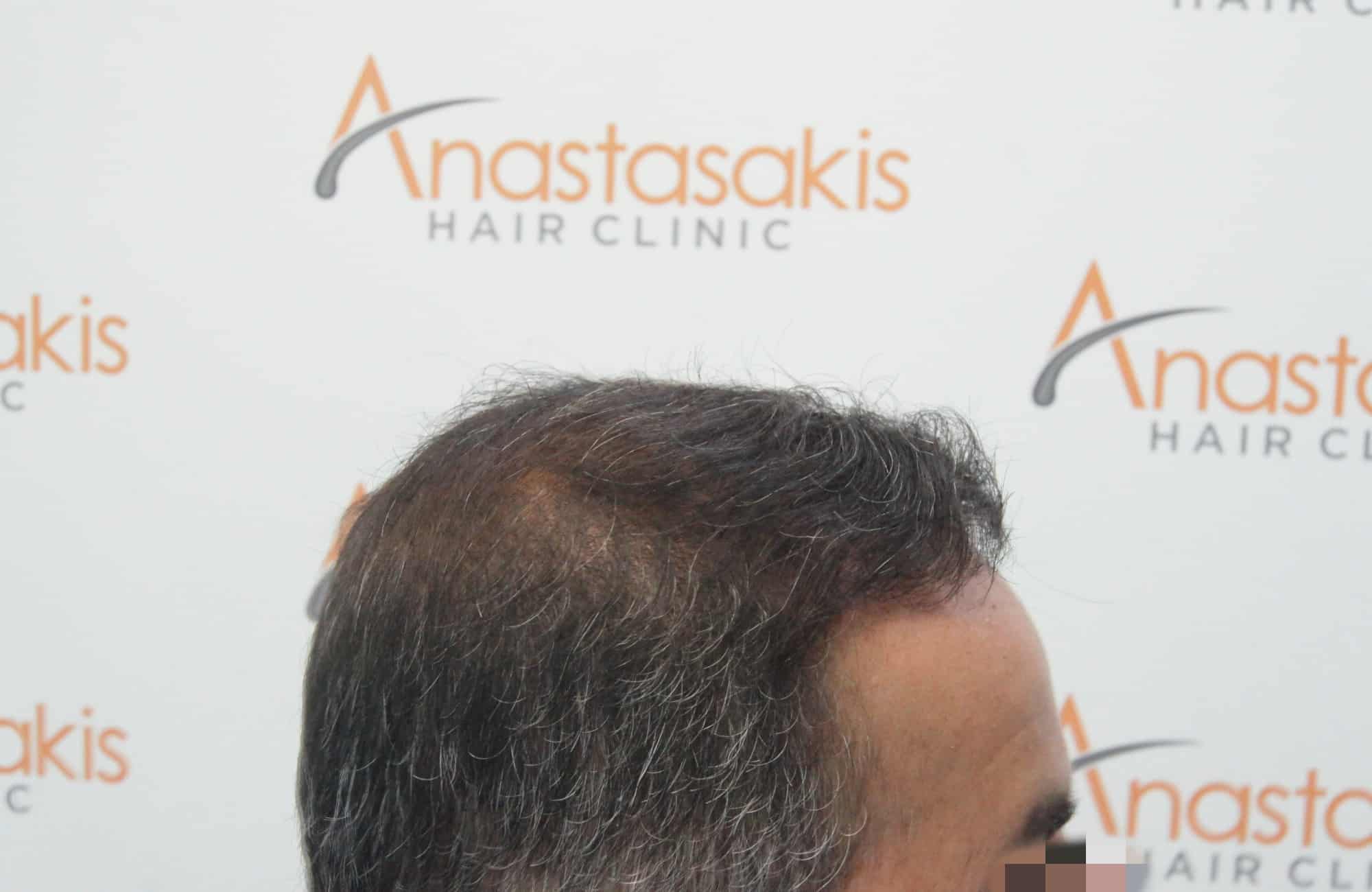 μεταμοσχευση μαλλιων πριν και μετα