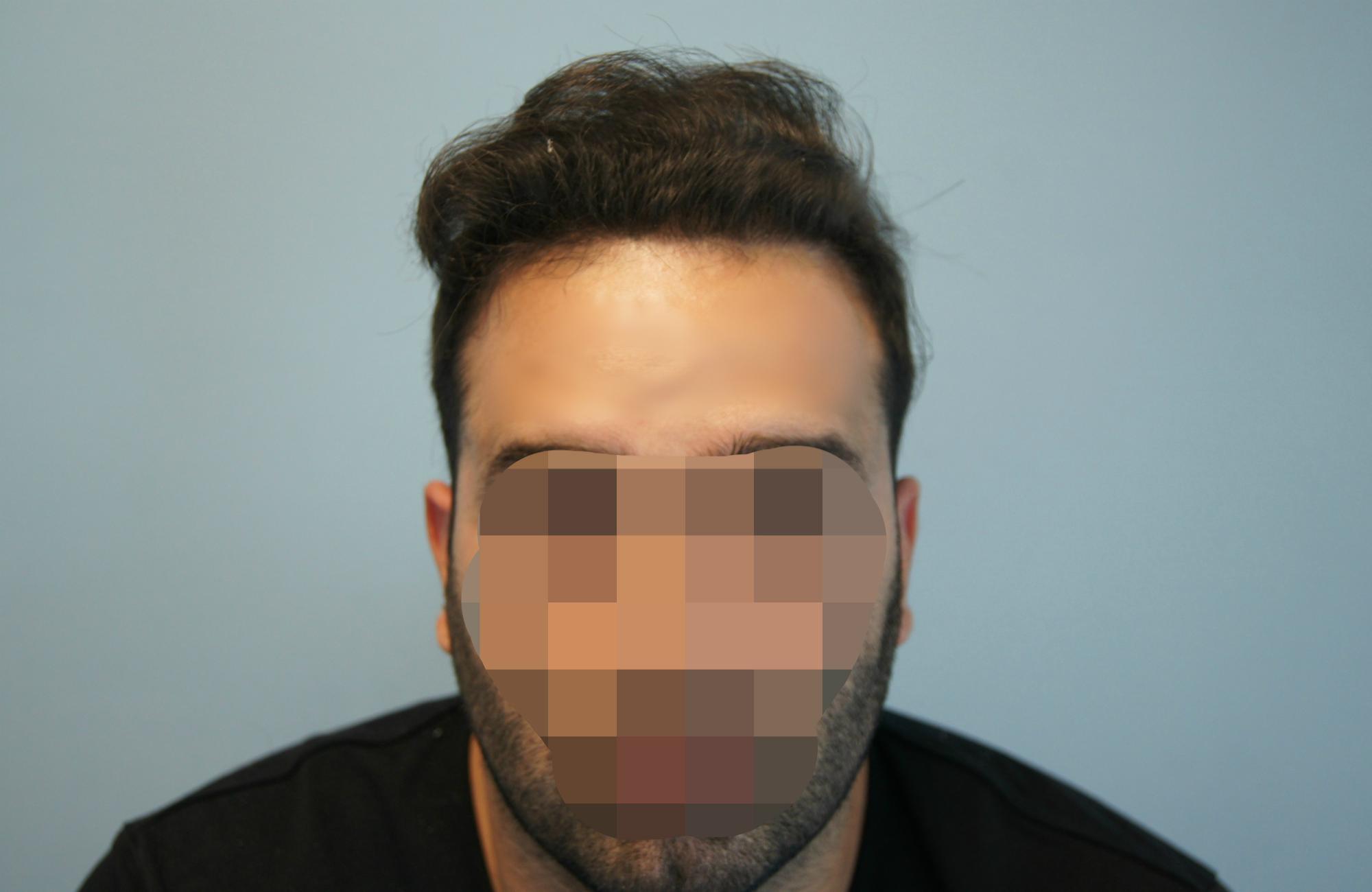 μεταμοσχευση μαλλιων πριν και μετα