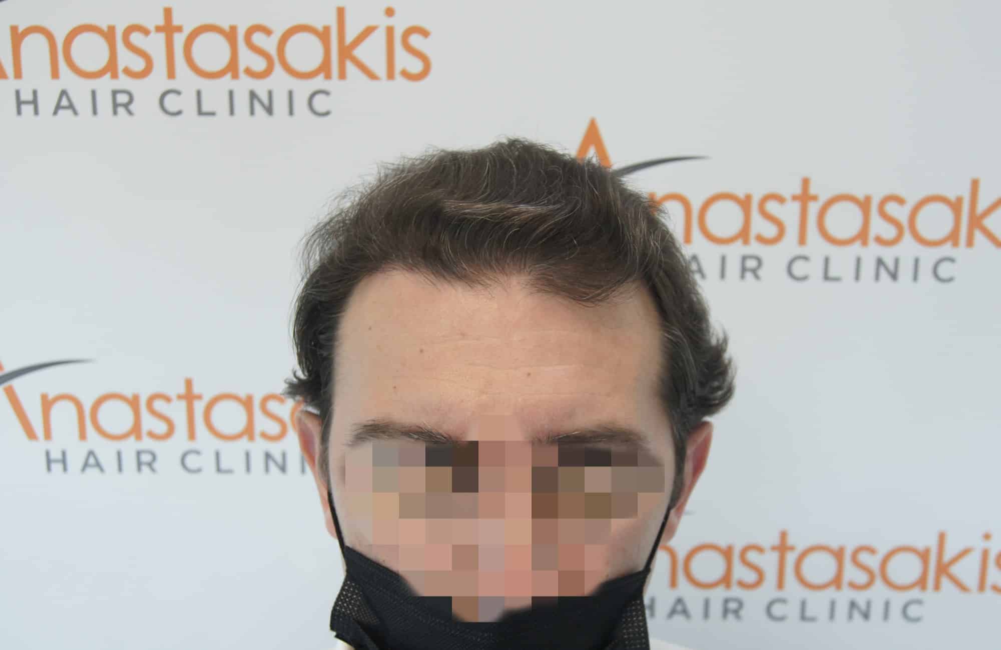 μεταμοσχευση μαλλιων πριν και μετα