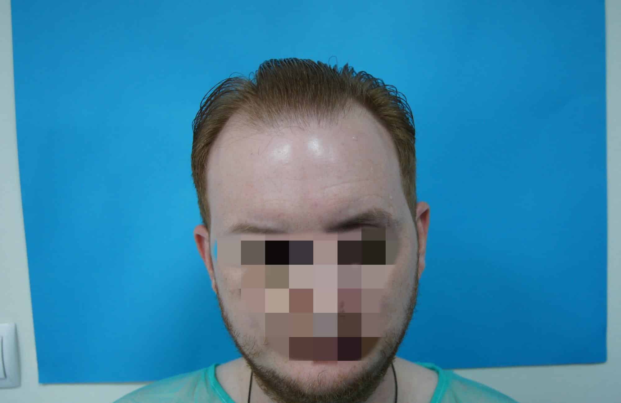 Αποτέλεσμα με 2300 FUs