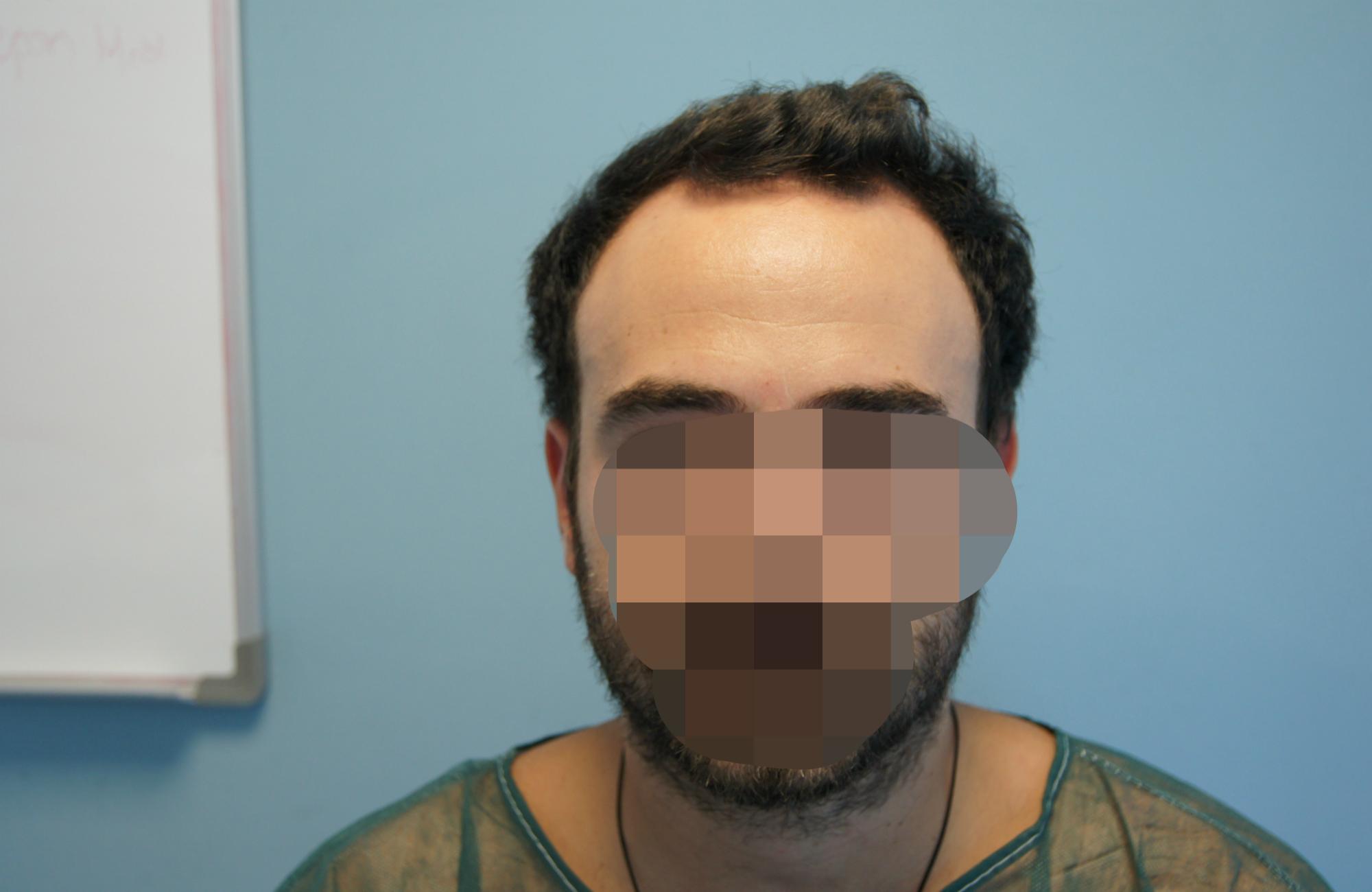 μεταμοσχευση μαλλιων πριν και μετα