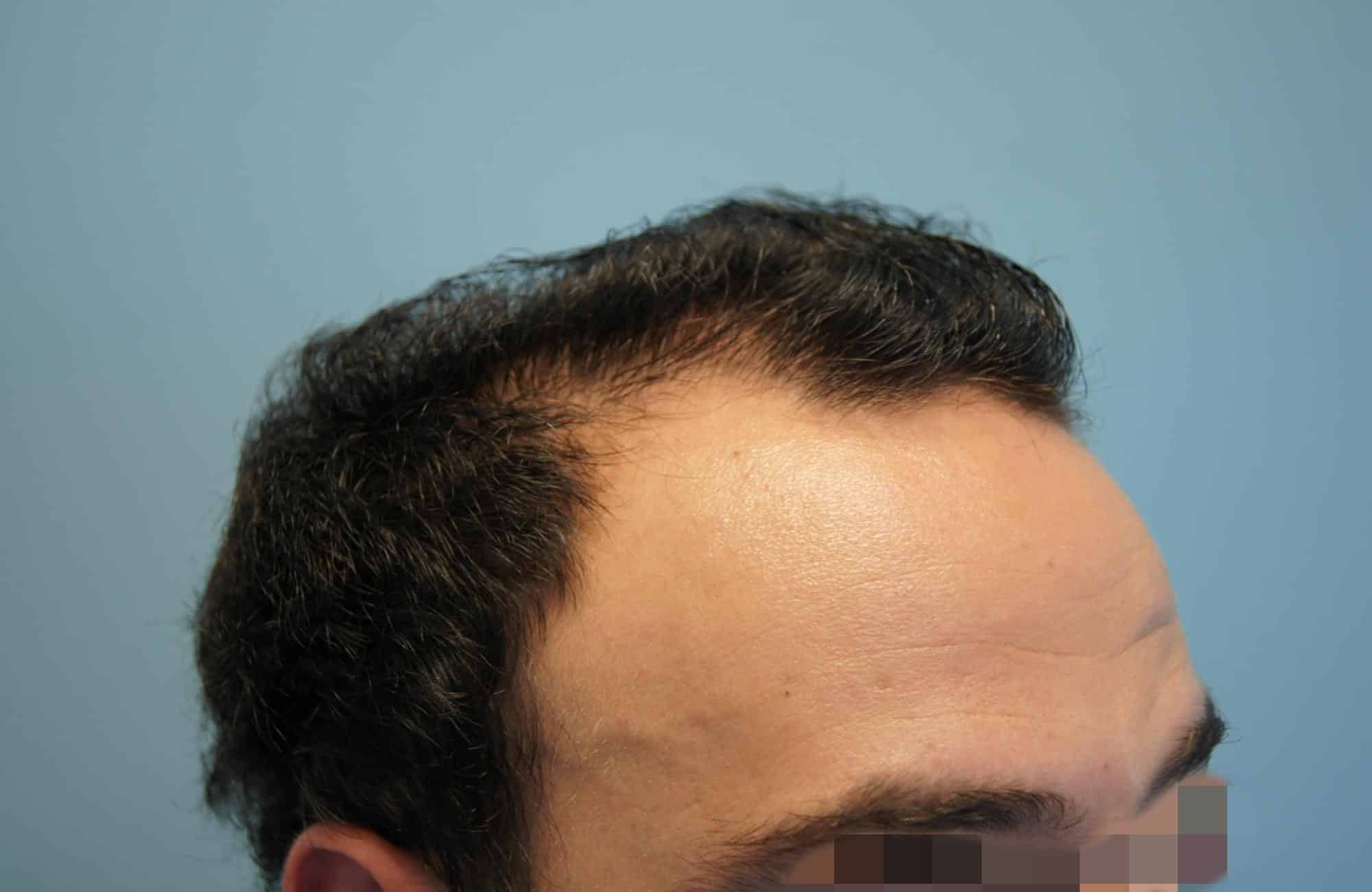 μεταμοσχευση μαλλιων πριν και μετα