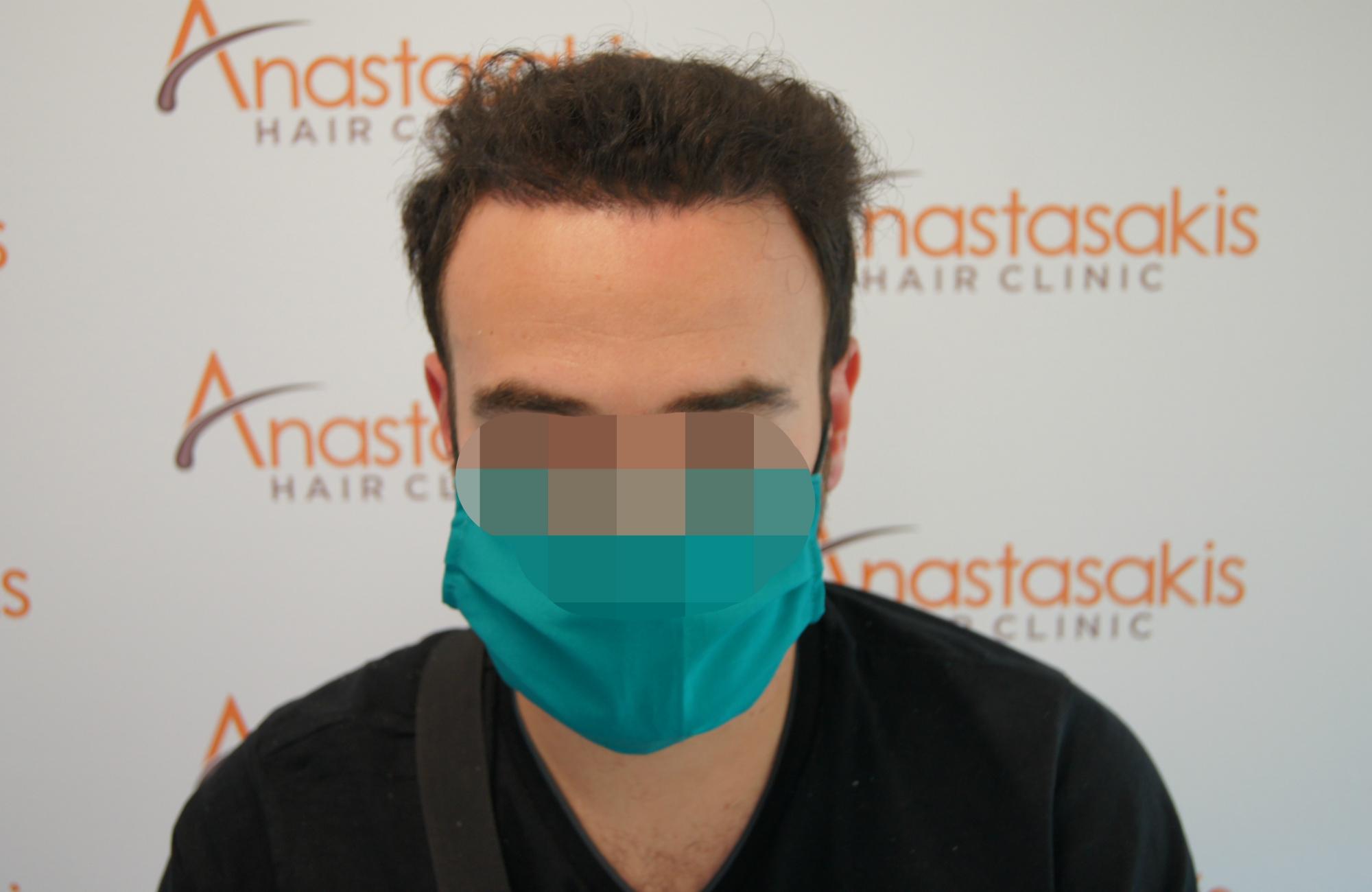 μεταμοσχευση μαλλιων πριν και μετα