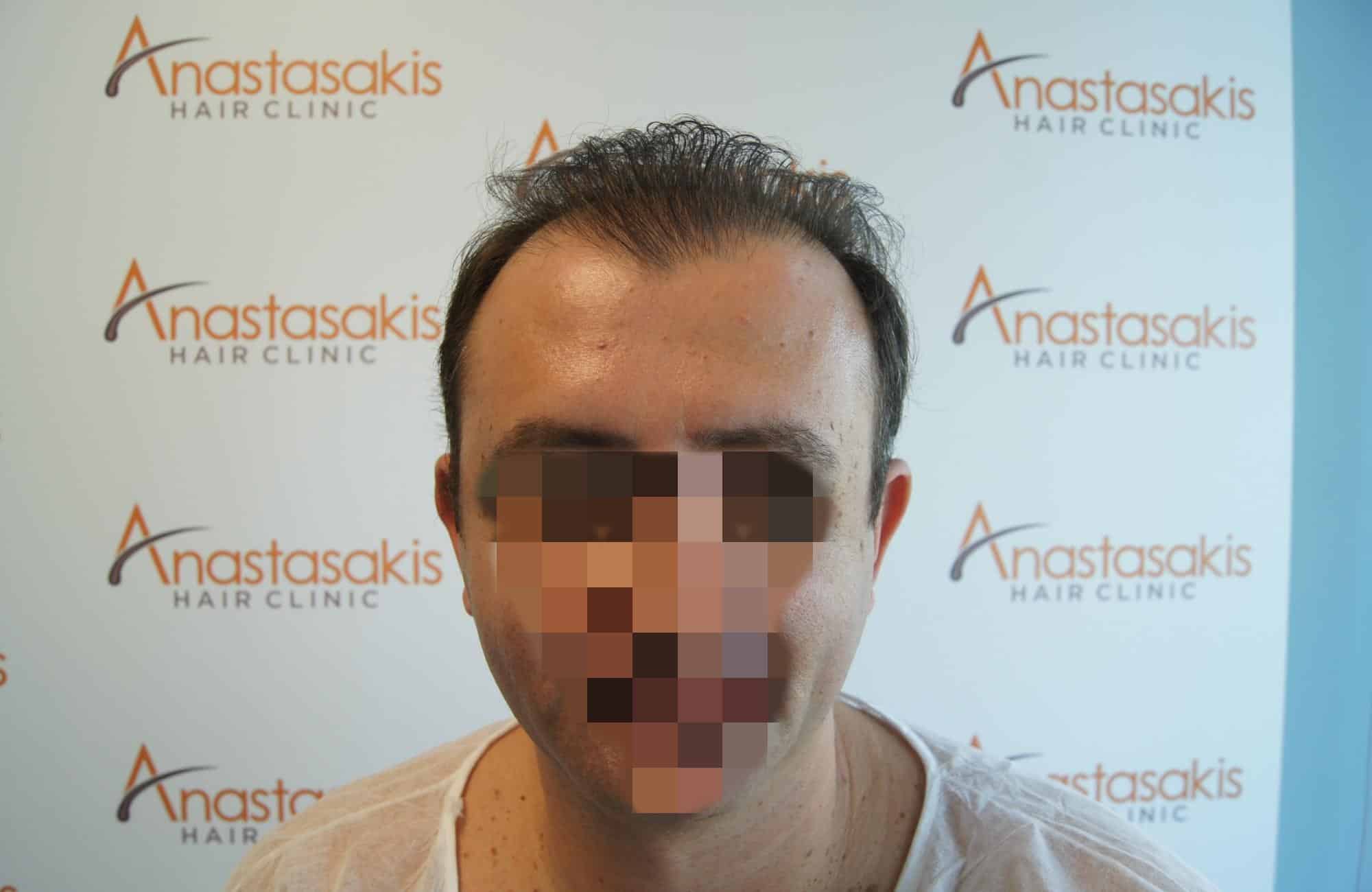 μεταμοσχευση μαλλιων πριν και μετα