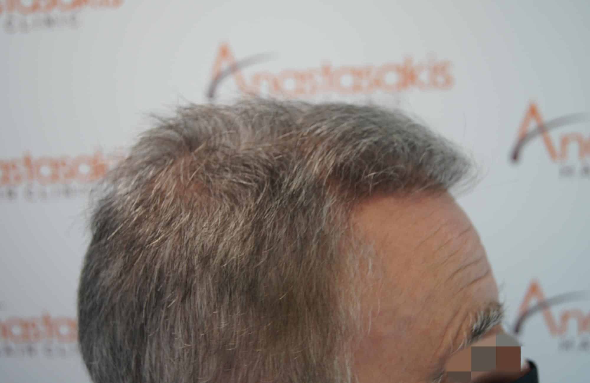 μεταμοσχευση μαλλιων πριν και μετα