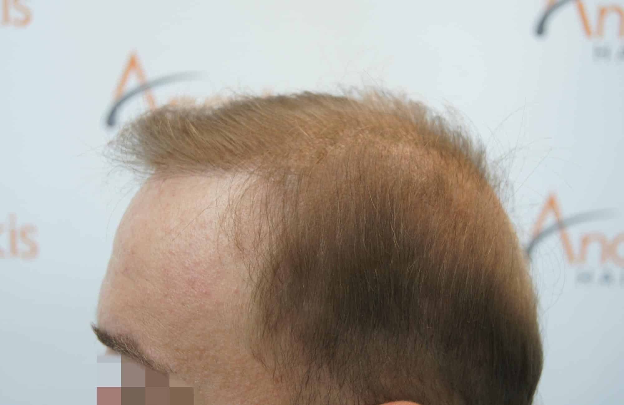 μεταμοσχευση μαλλιων πριν και μετα