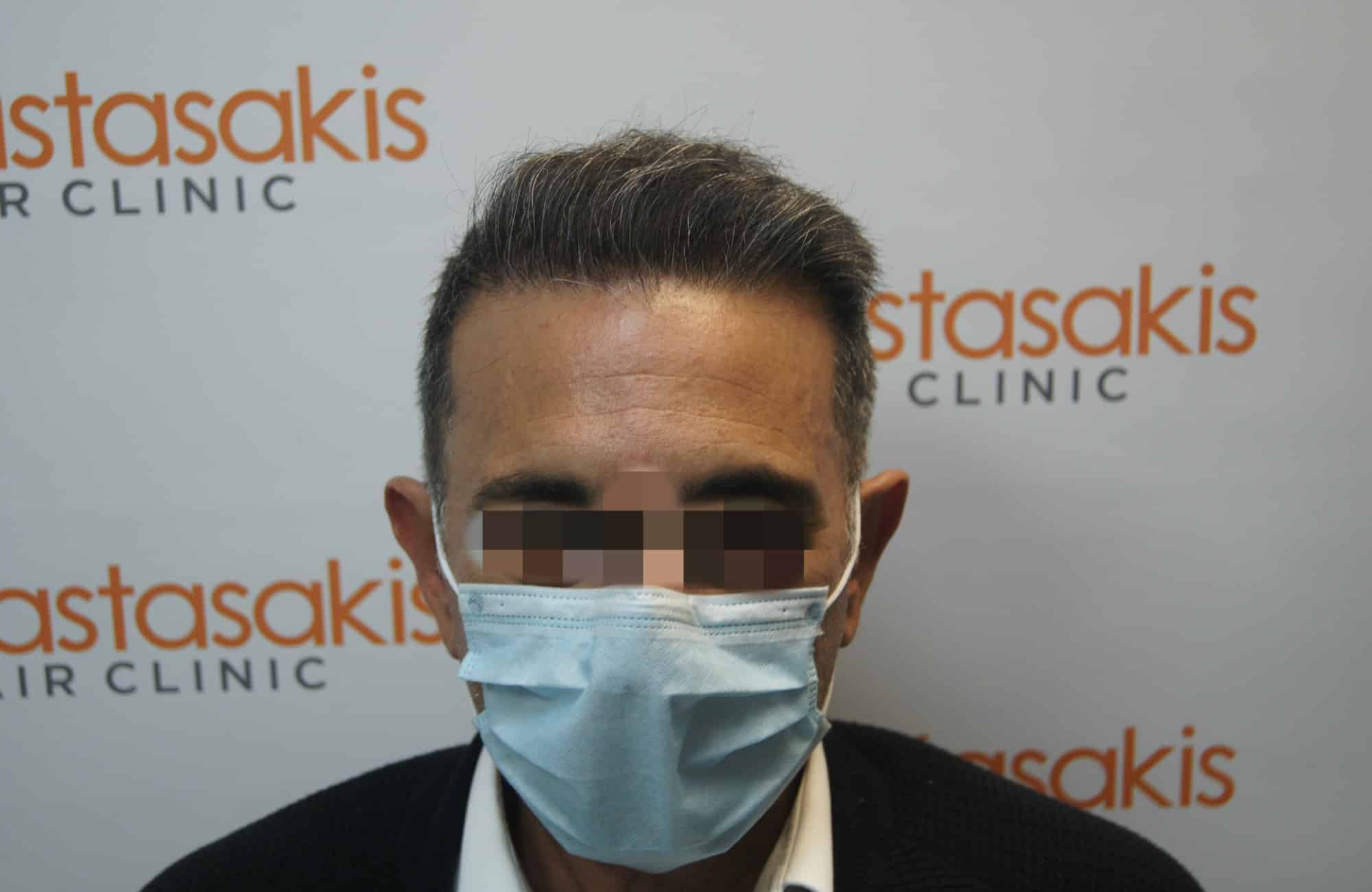 μεταμοσχευση μαλλιων πριν και μετα