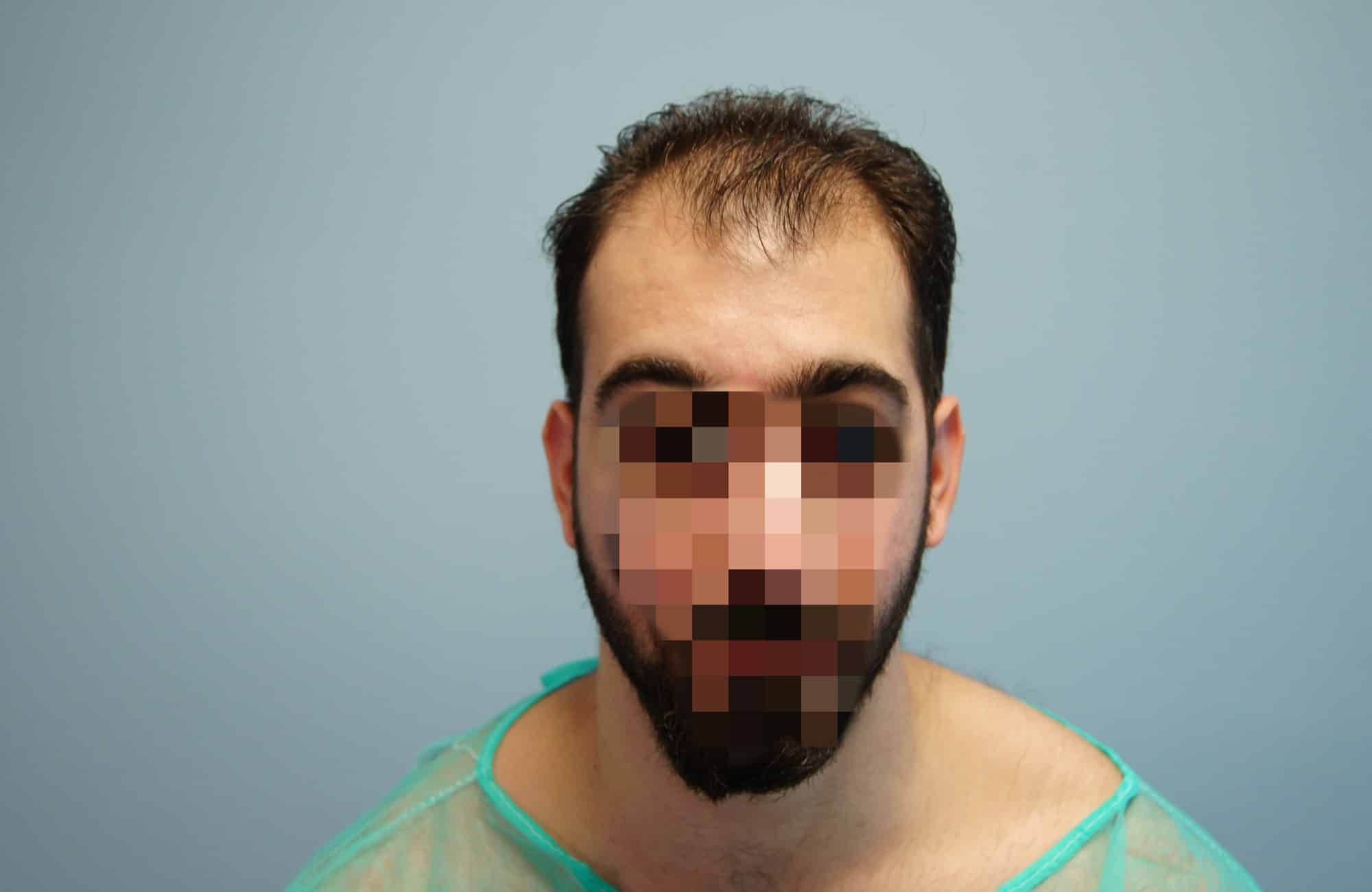 μεταμοσχευση μαλλιων πριν και μετα