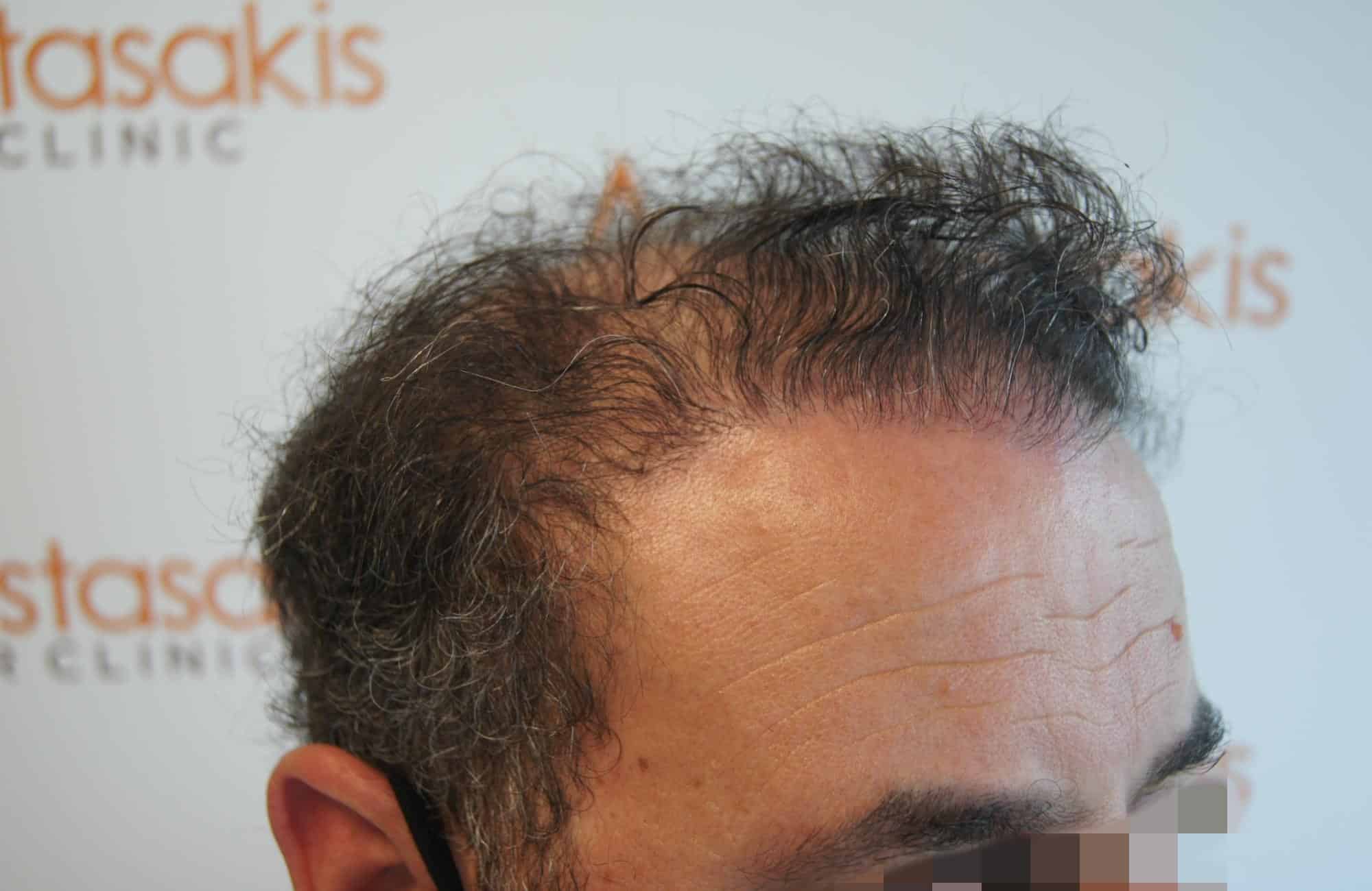 μεταμοσχευση μαλλιων πριν και μετα