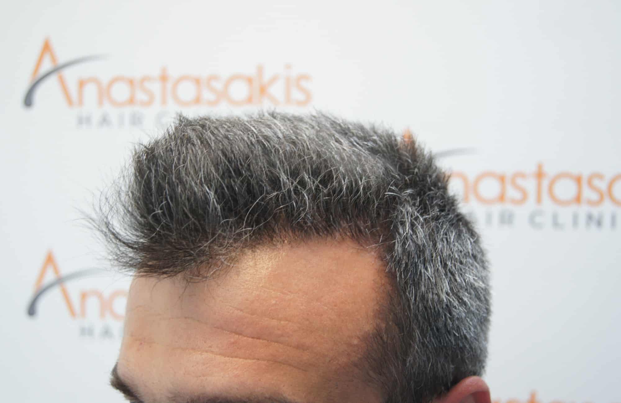 μεταμοσχευση μαλλιων πριν και μετα