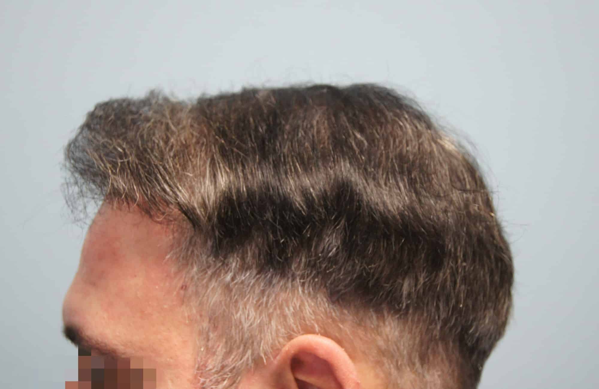 μεταμοσχευση μαλλιων πριν και μετα