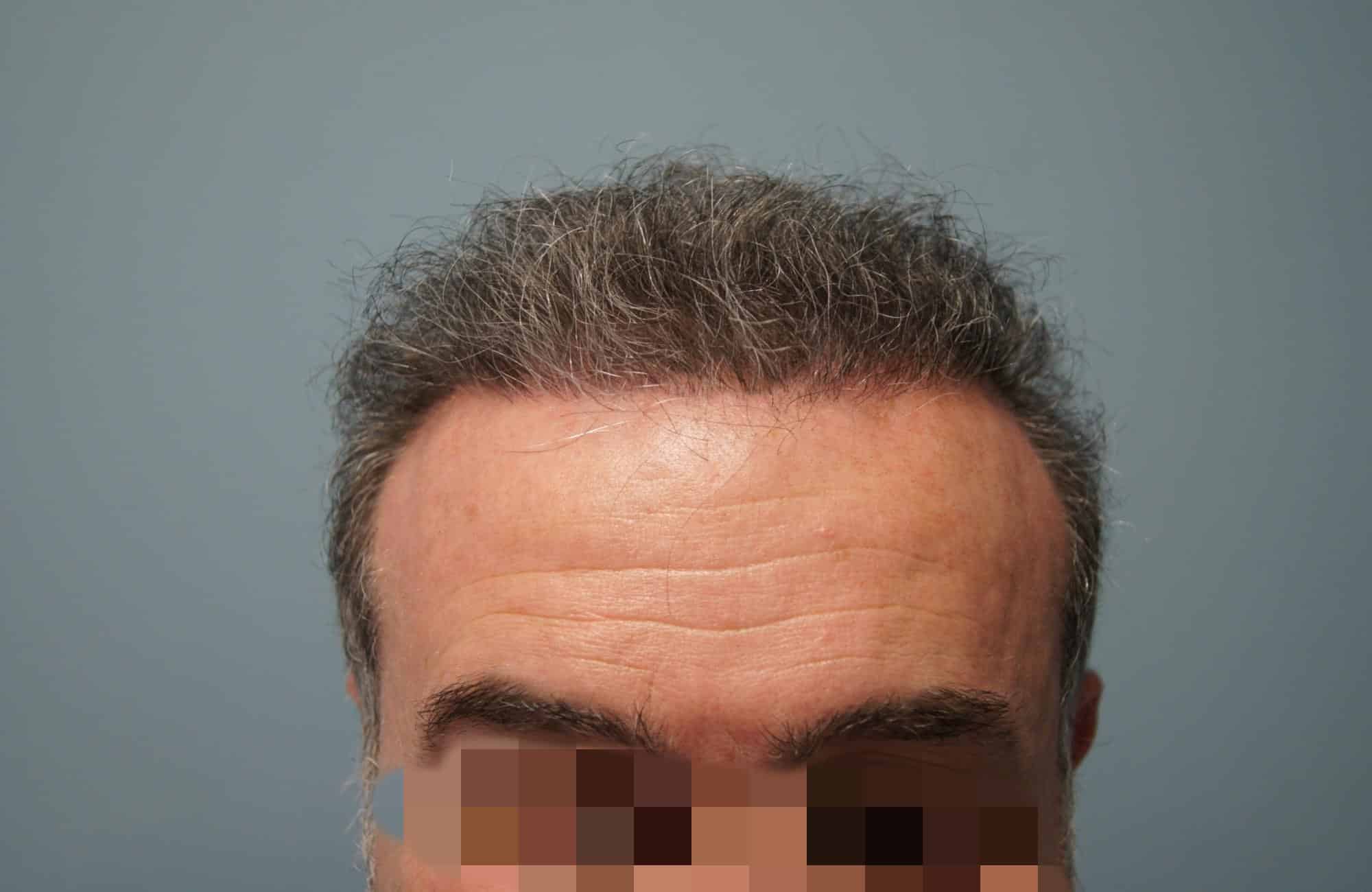 μεταμοσχευση μαλλιων πριν και μετα
