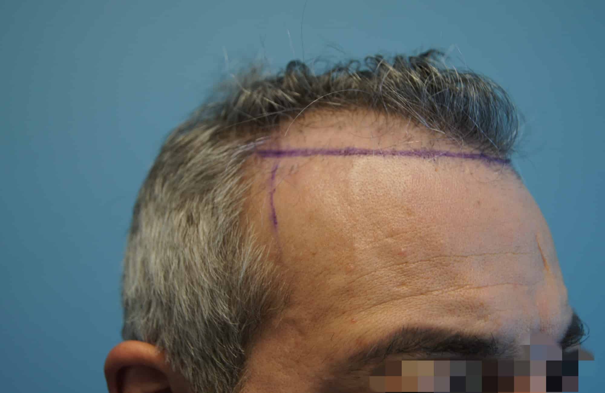 μεταμοσχευση μαλλιων πριν και μετα