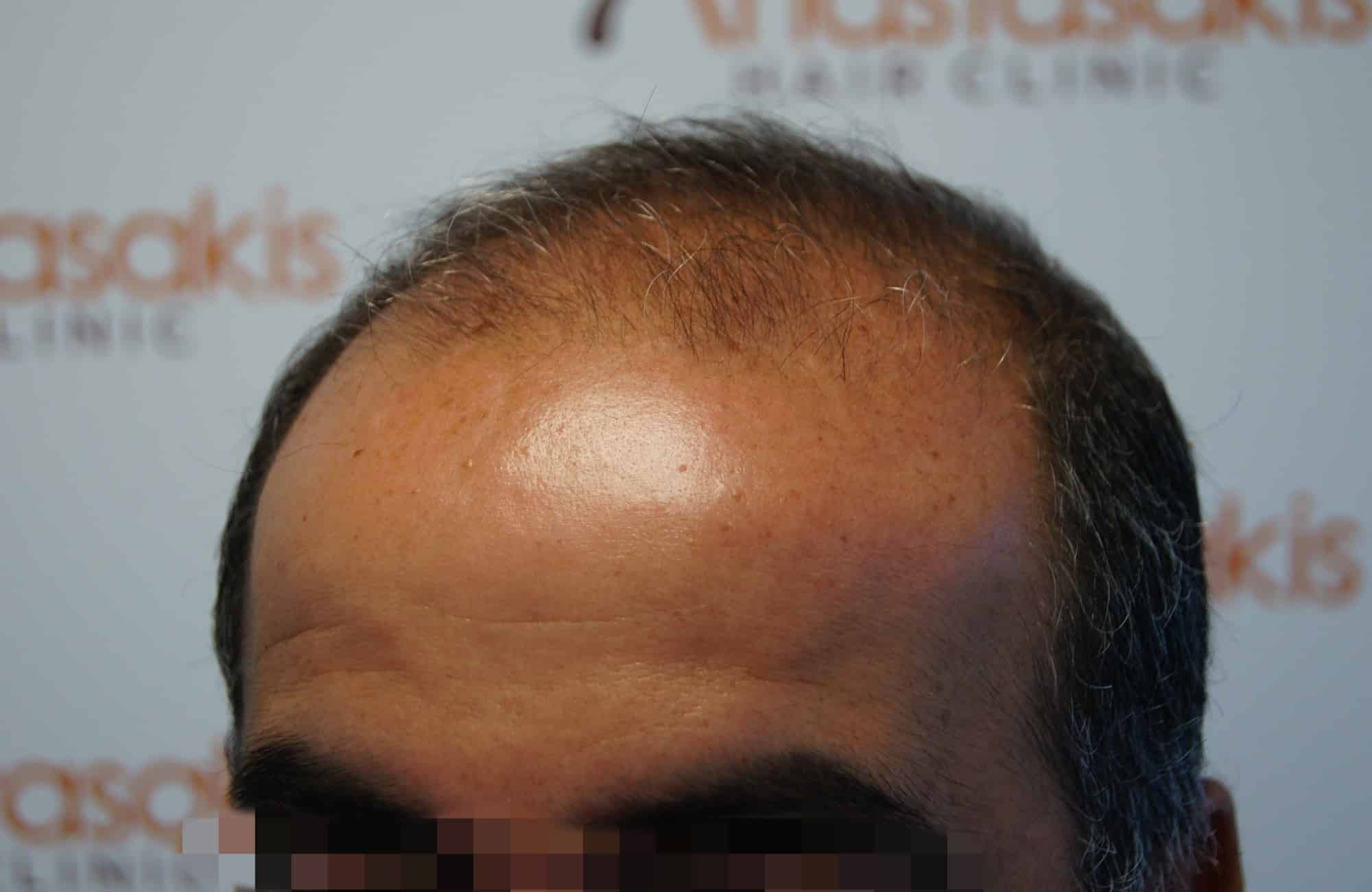 μεταμοσχευση μαλλιων πριν και μετα