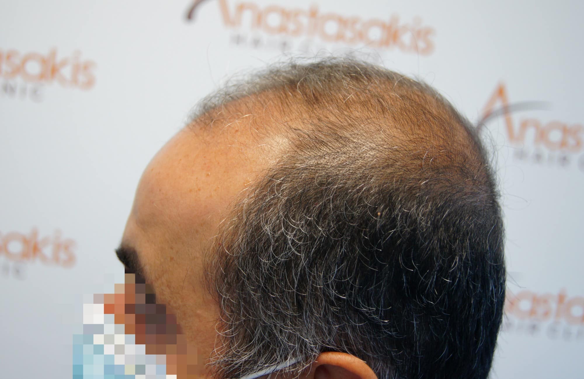 μεταμοσχευση μαλλιων πριν και μετα