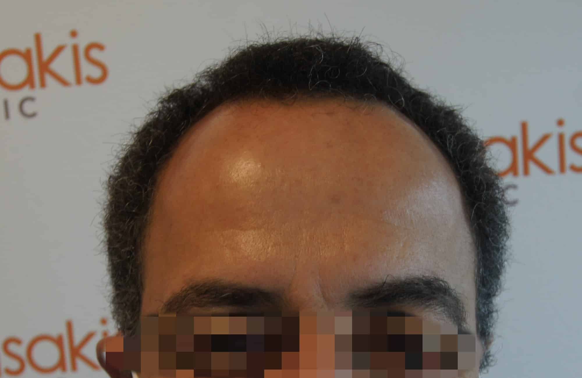 μεταμοσχευση μαλλιων πριν και μετα
