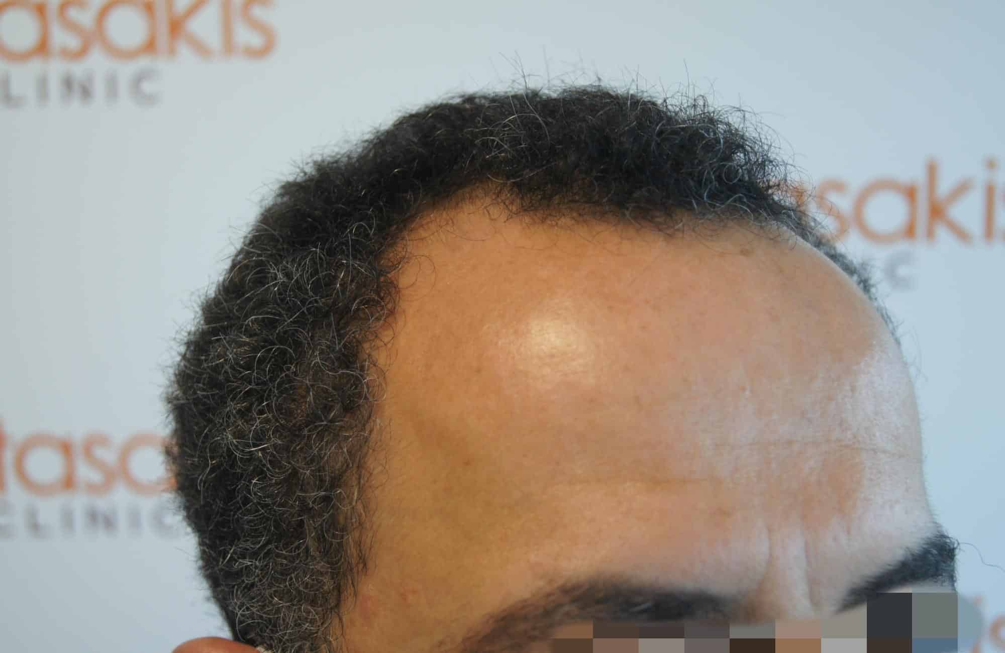 μεταμοσχευση μαλλιων πριν και μετα