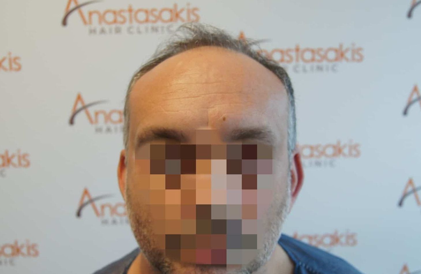 μεταμοσχευση μαλλιων πριν και μετα
