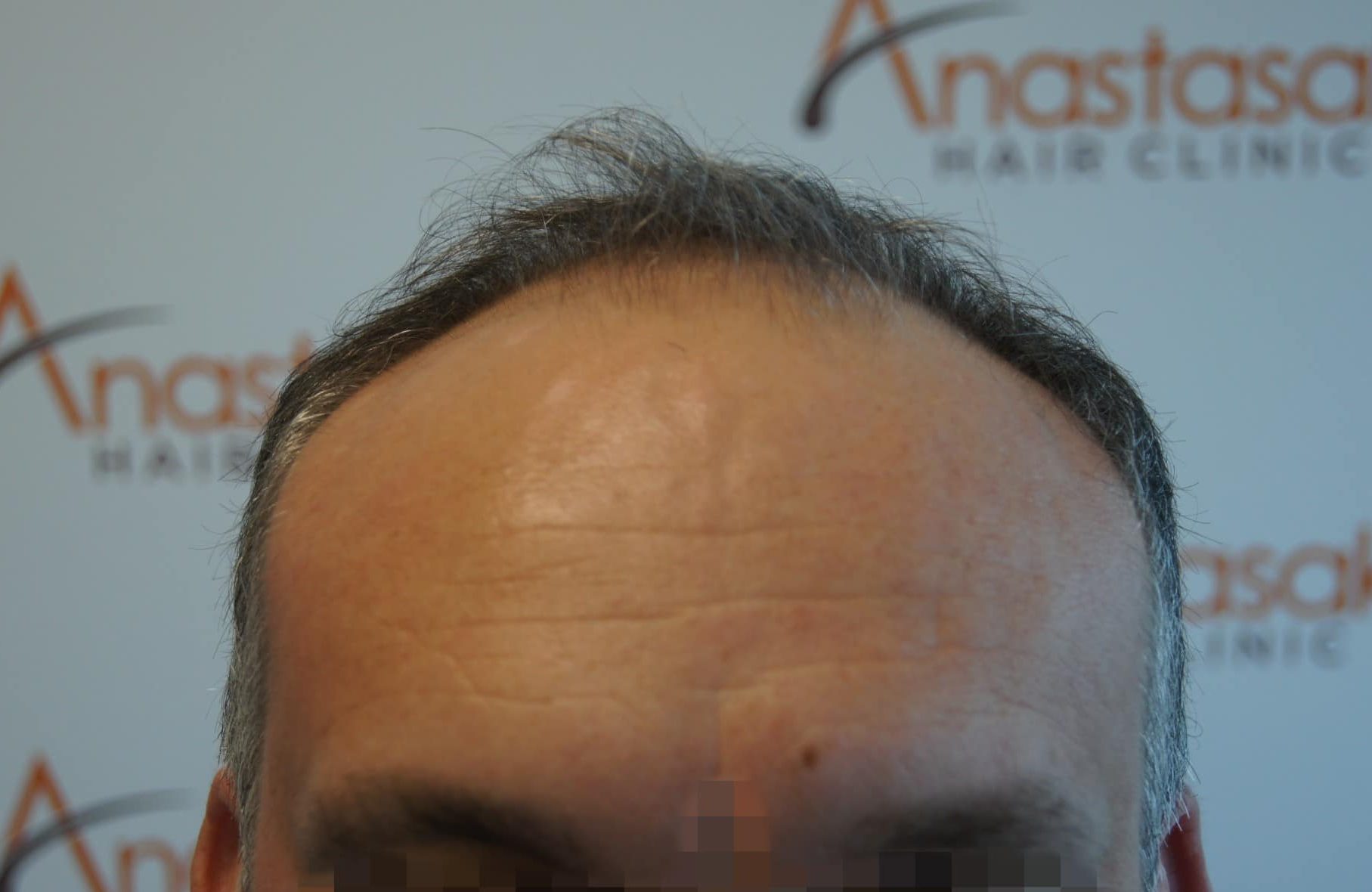 μεταμοσχευση μαλλιων πριν και μετα