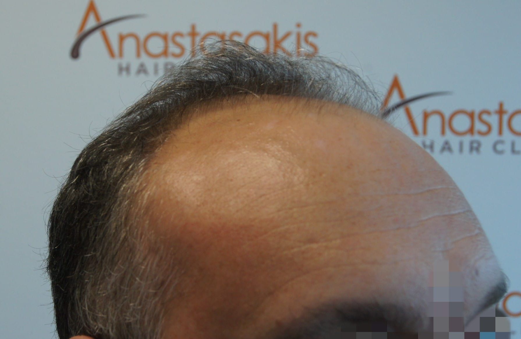 μεταμοσχευση μαλλιων πριν και μετα