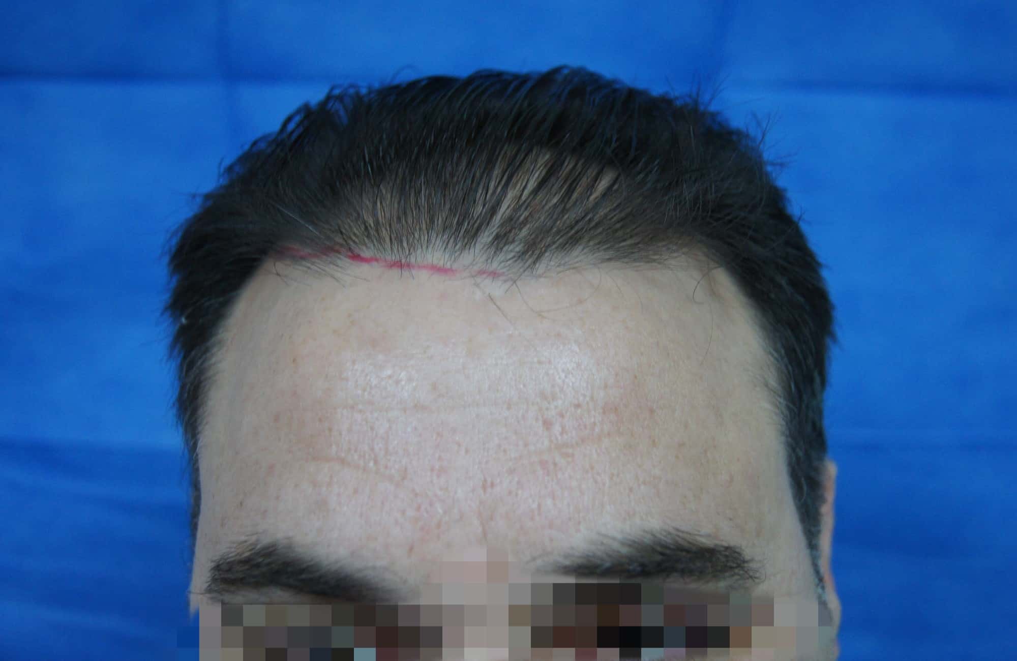 μεταμοσχευση μαλλιων πριν και μετα