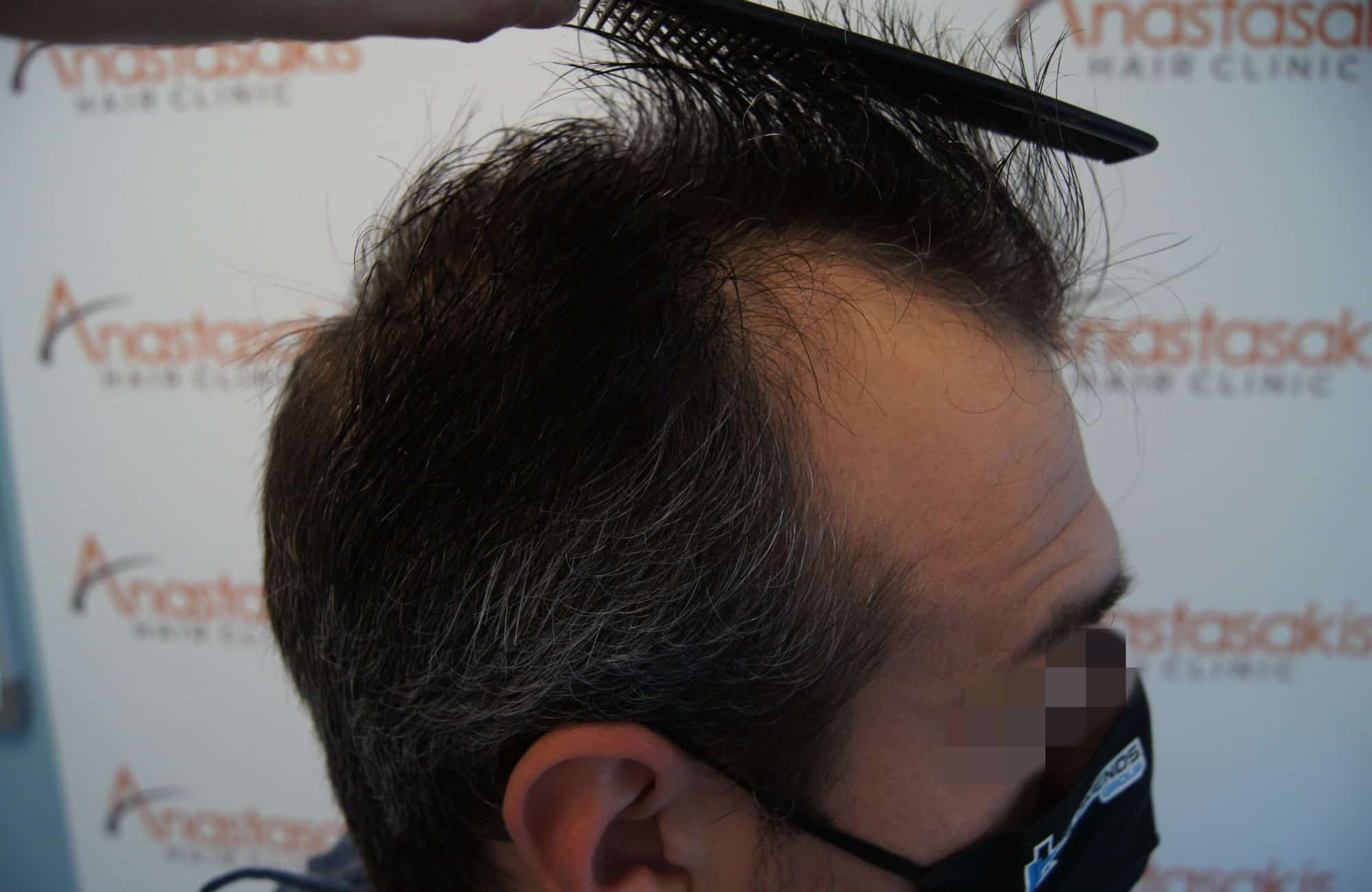 μεταμοσχευση μαλλιων πριν και μετα